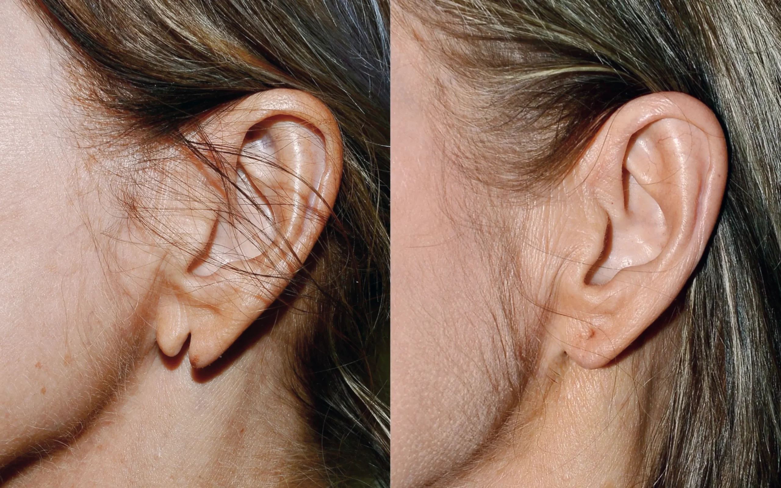 split earlobe repair