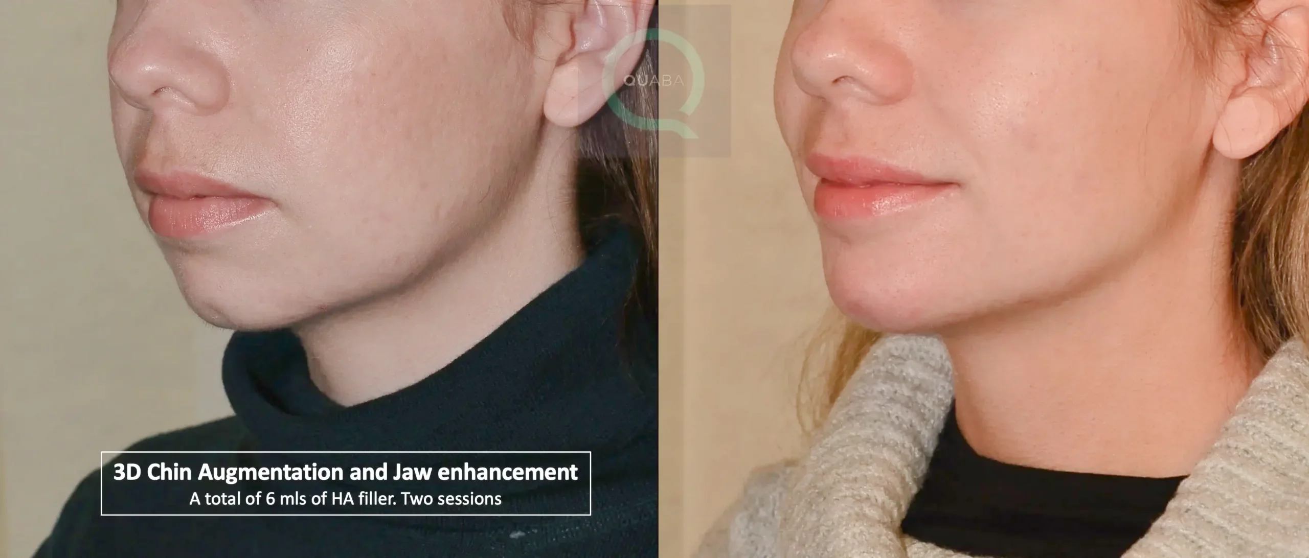 chin fillers