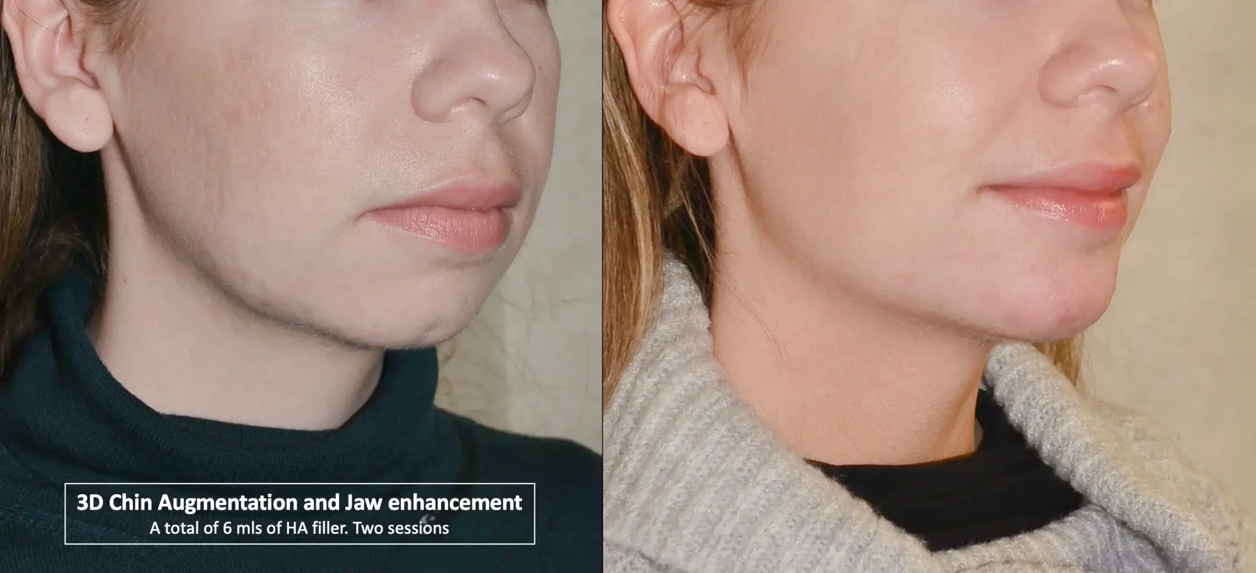 chin fillers