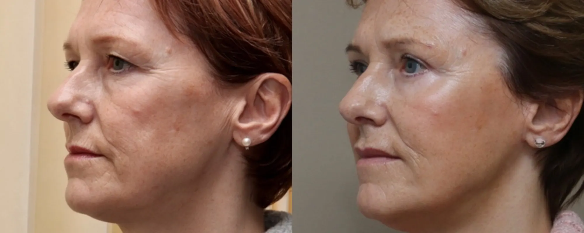 facial fat transfer