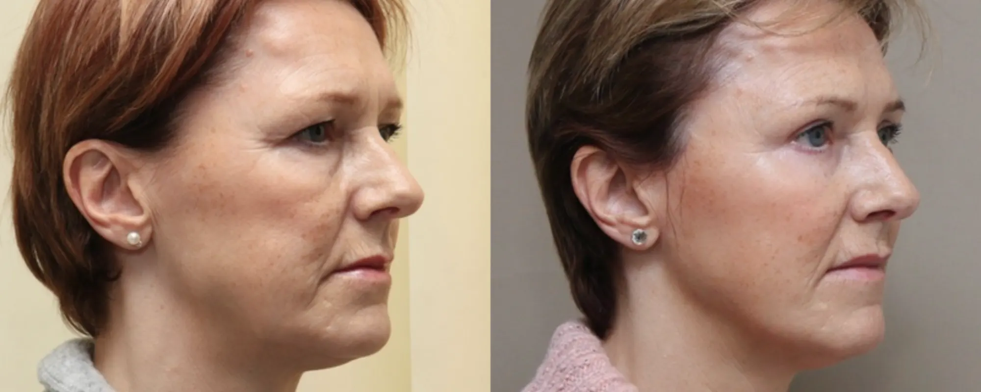 facial fat transfer