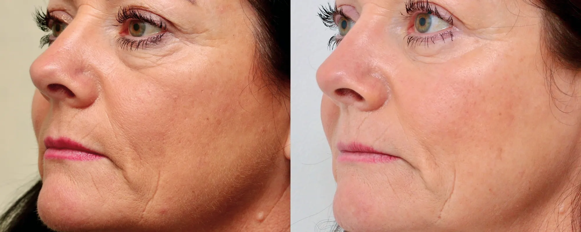 fat transfer to cheeks