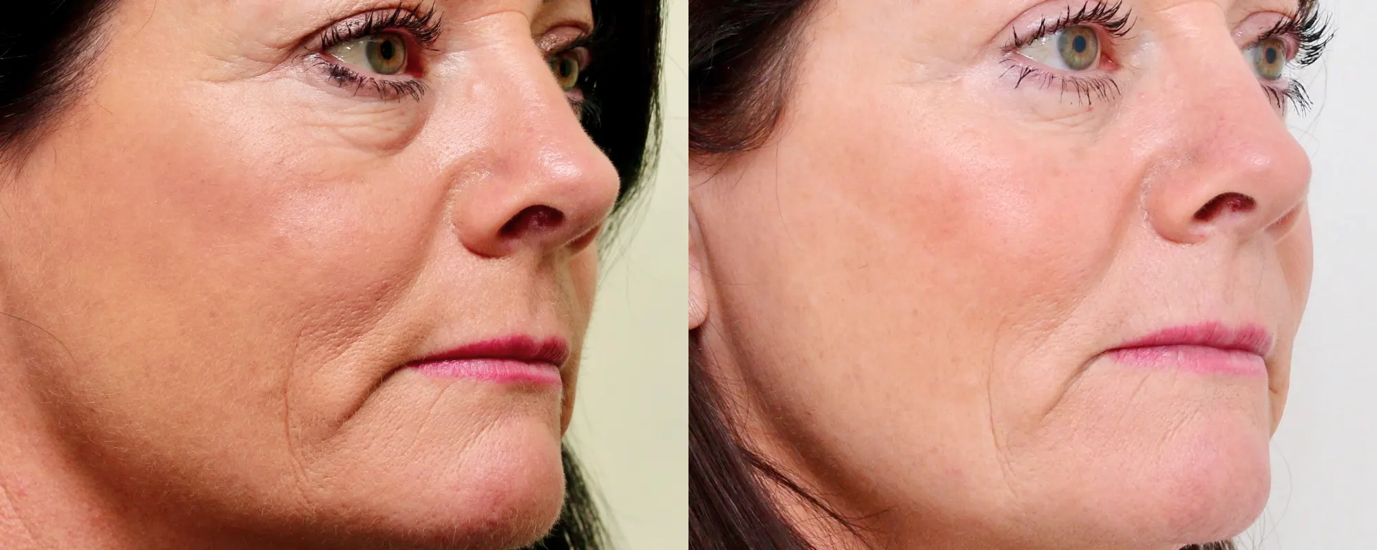 fat transfer to cheeks