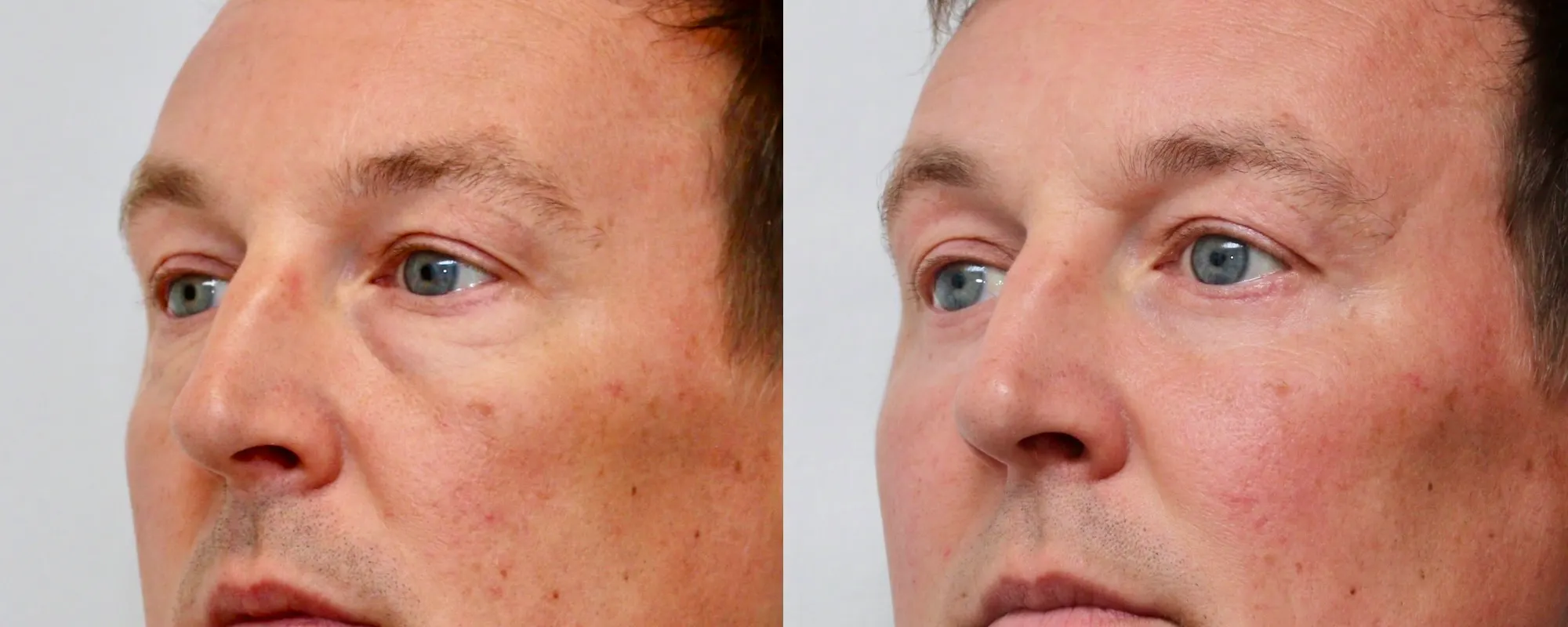fat transfer to cheeks