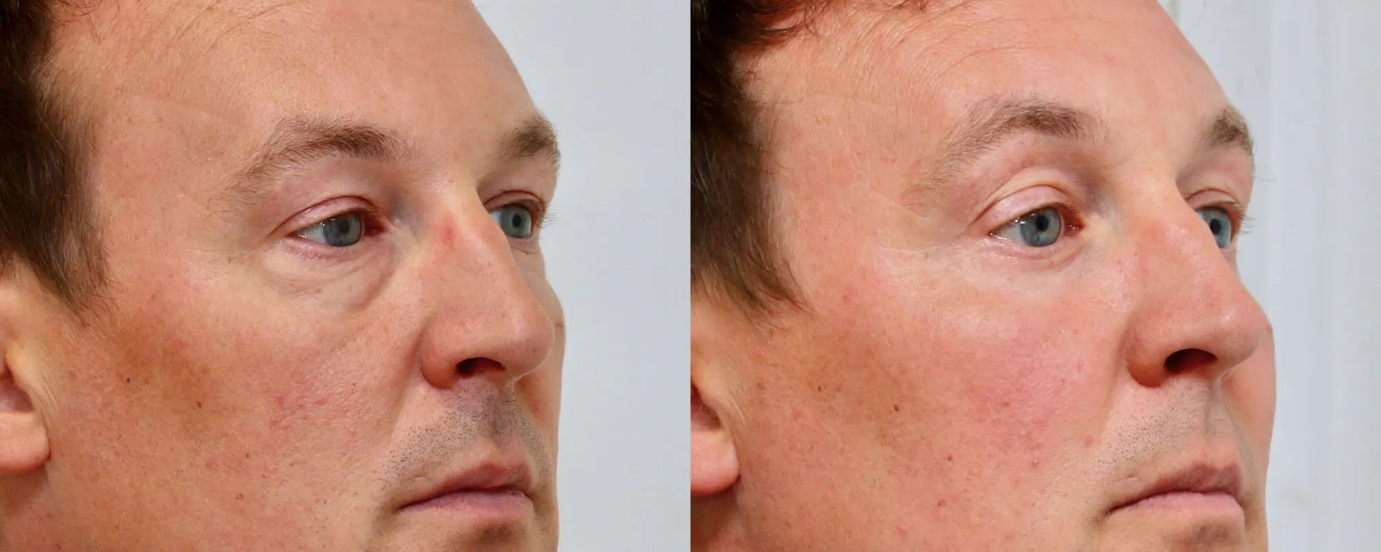 fat transfer to cheeks