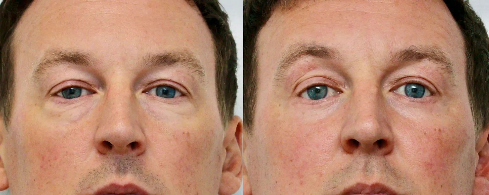 fat transfer to cheeks