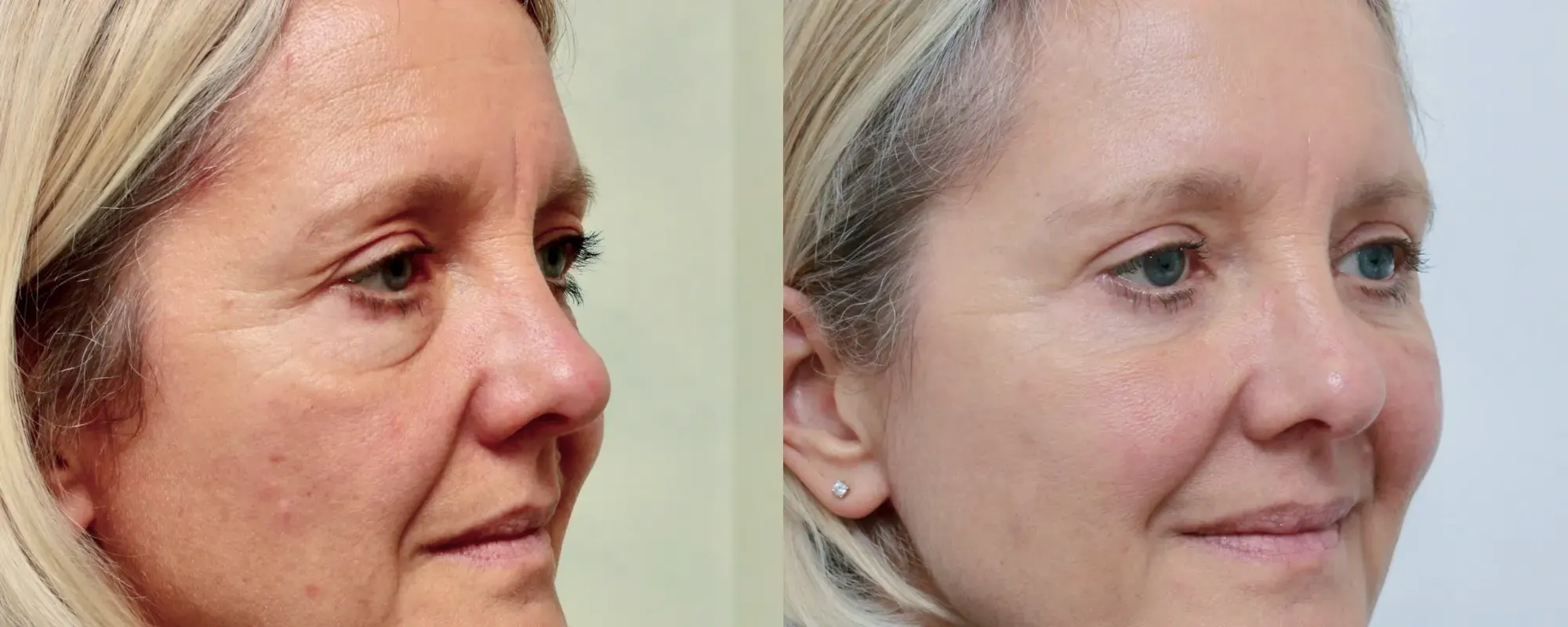 fat transfer to cheeks