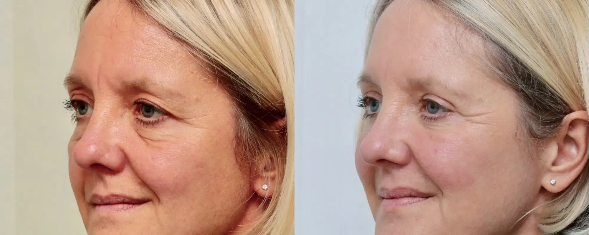 fat transfer to cheeks