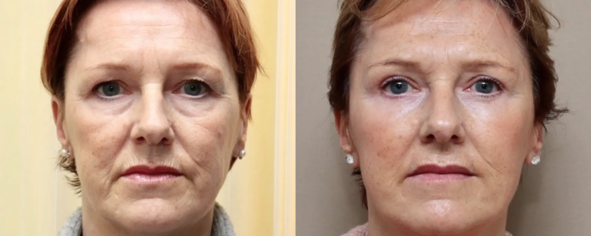 facial fat transfer