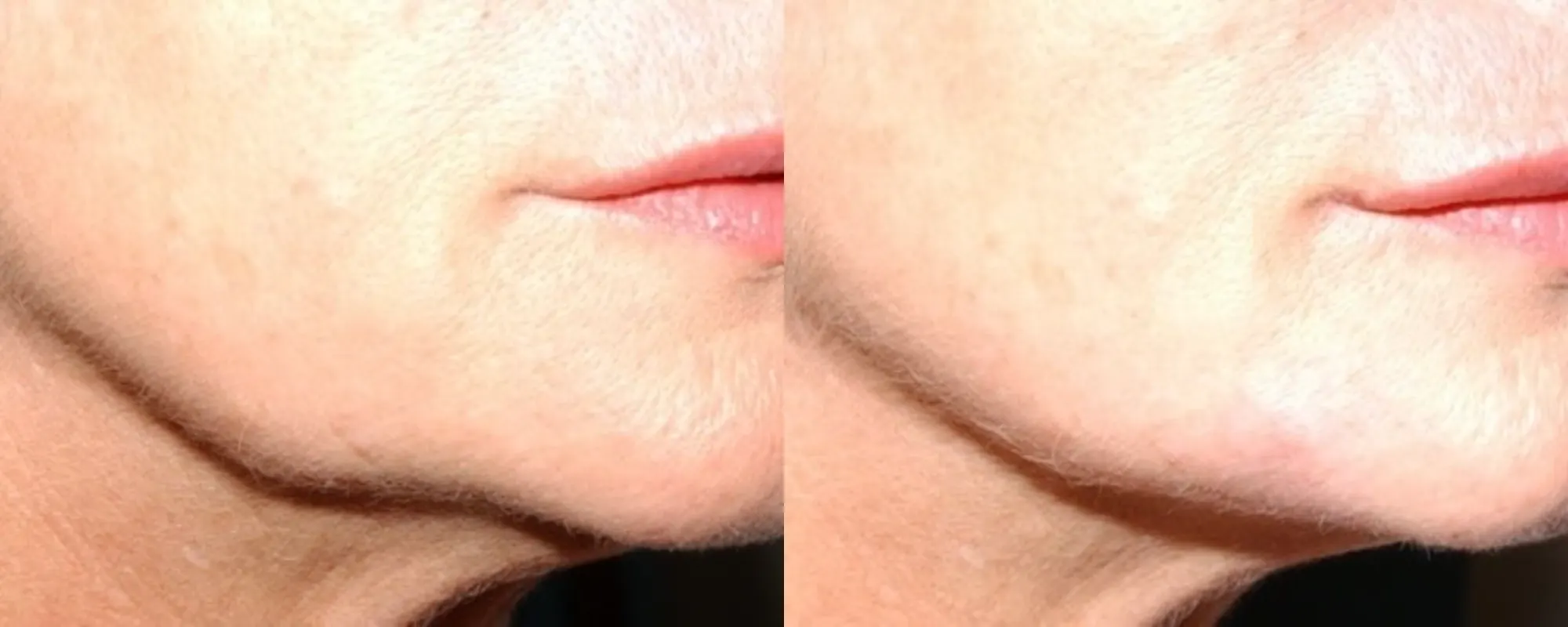 jowls