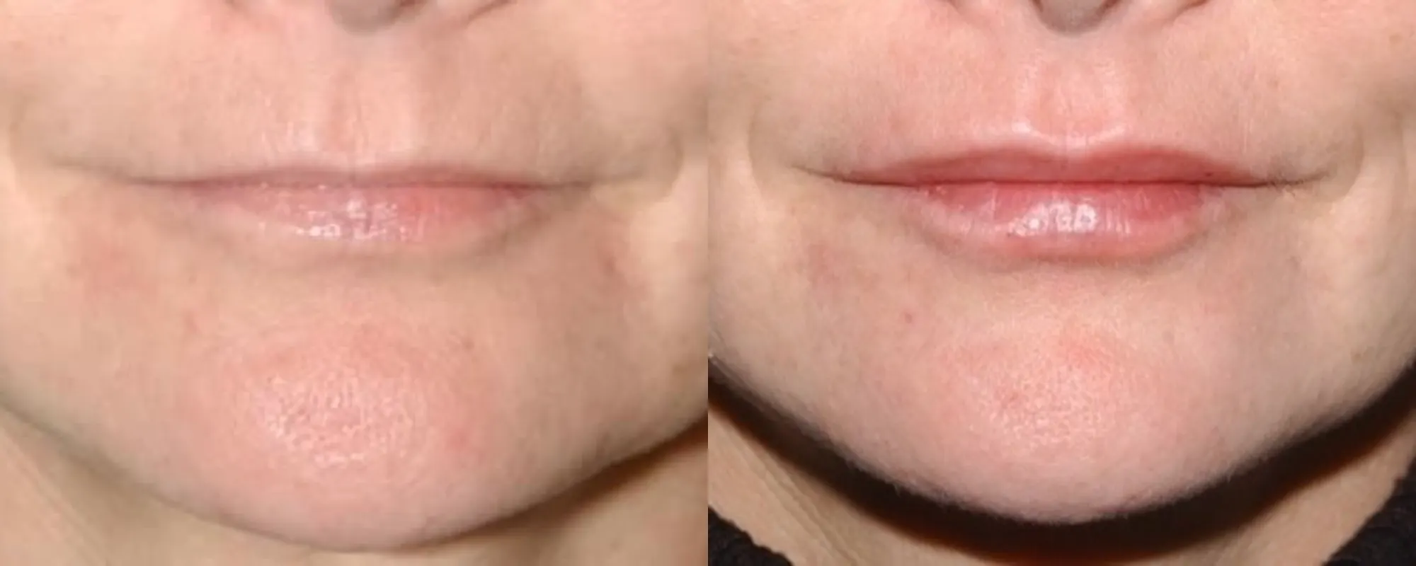 lip filler