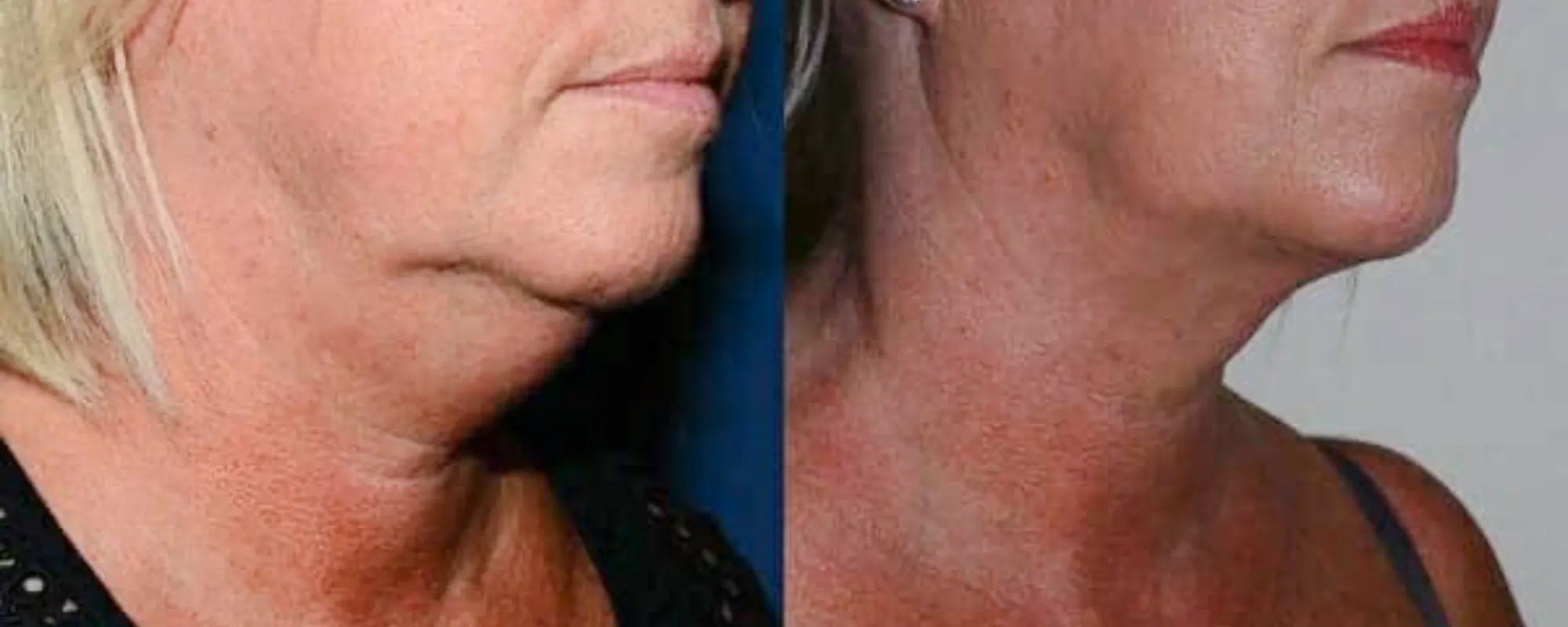 neck liposuction