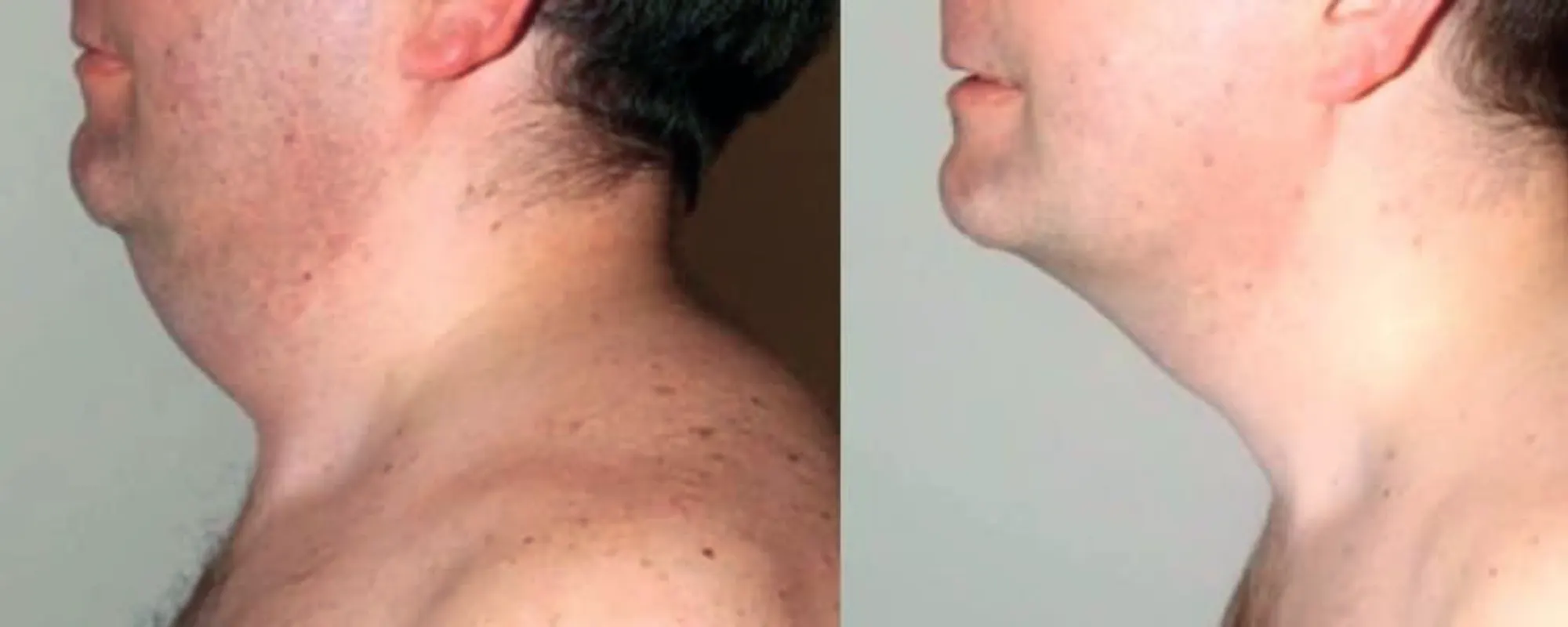 neck liposuction