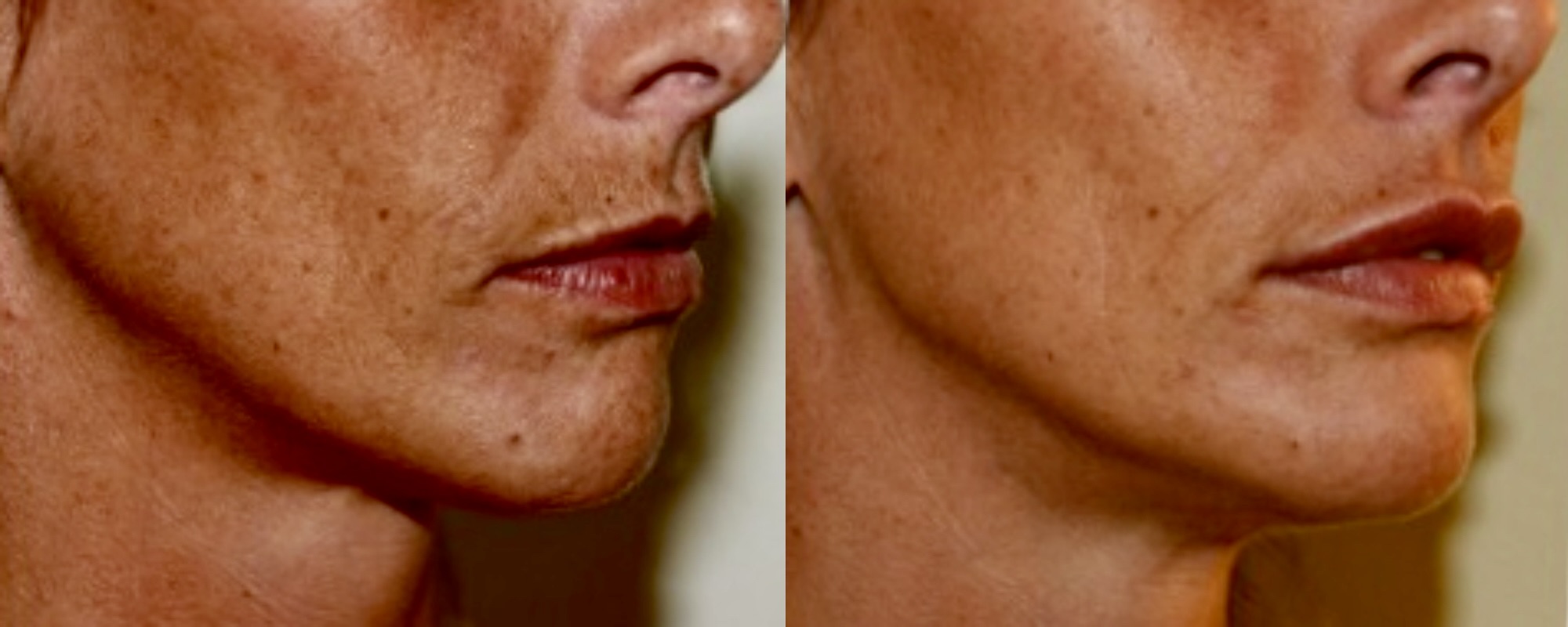 upper lip