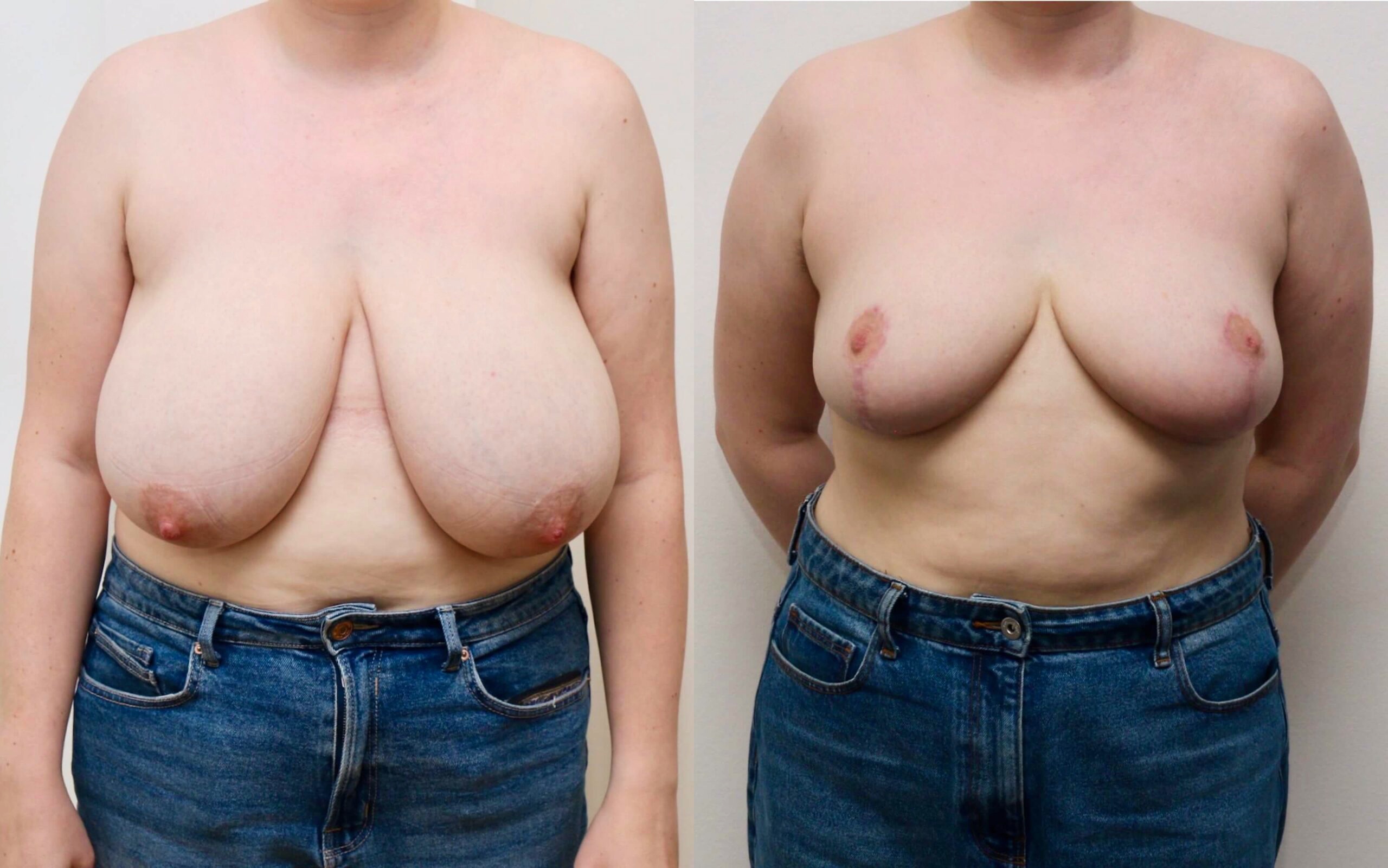 breast reduction