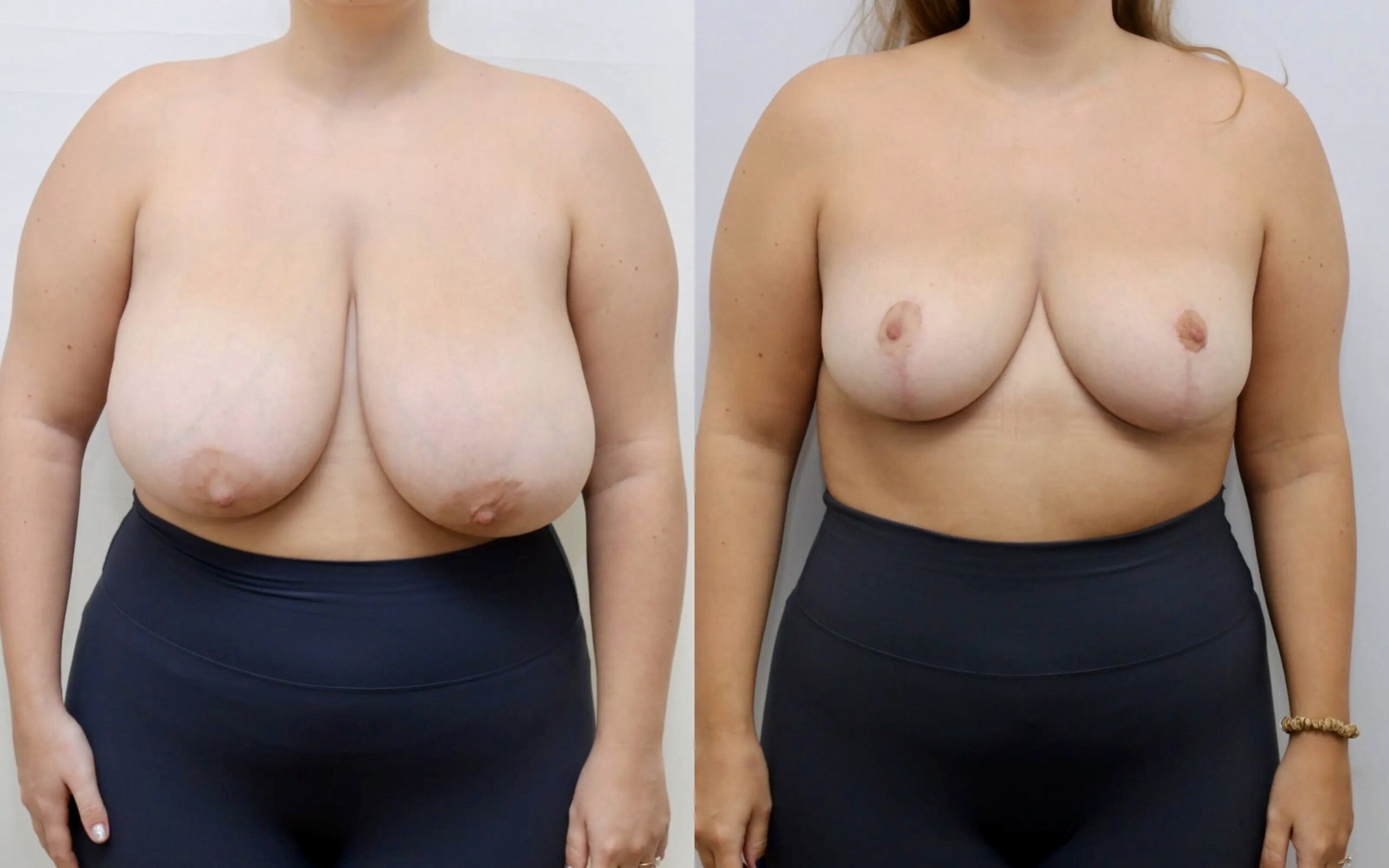 breast reduction