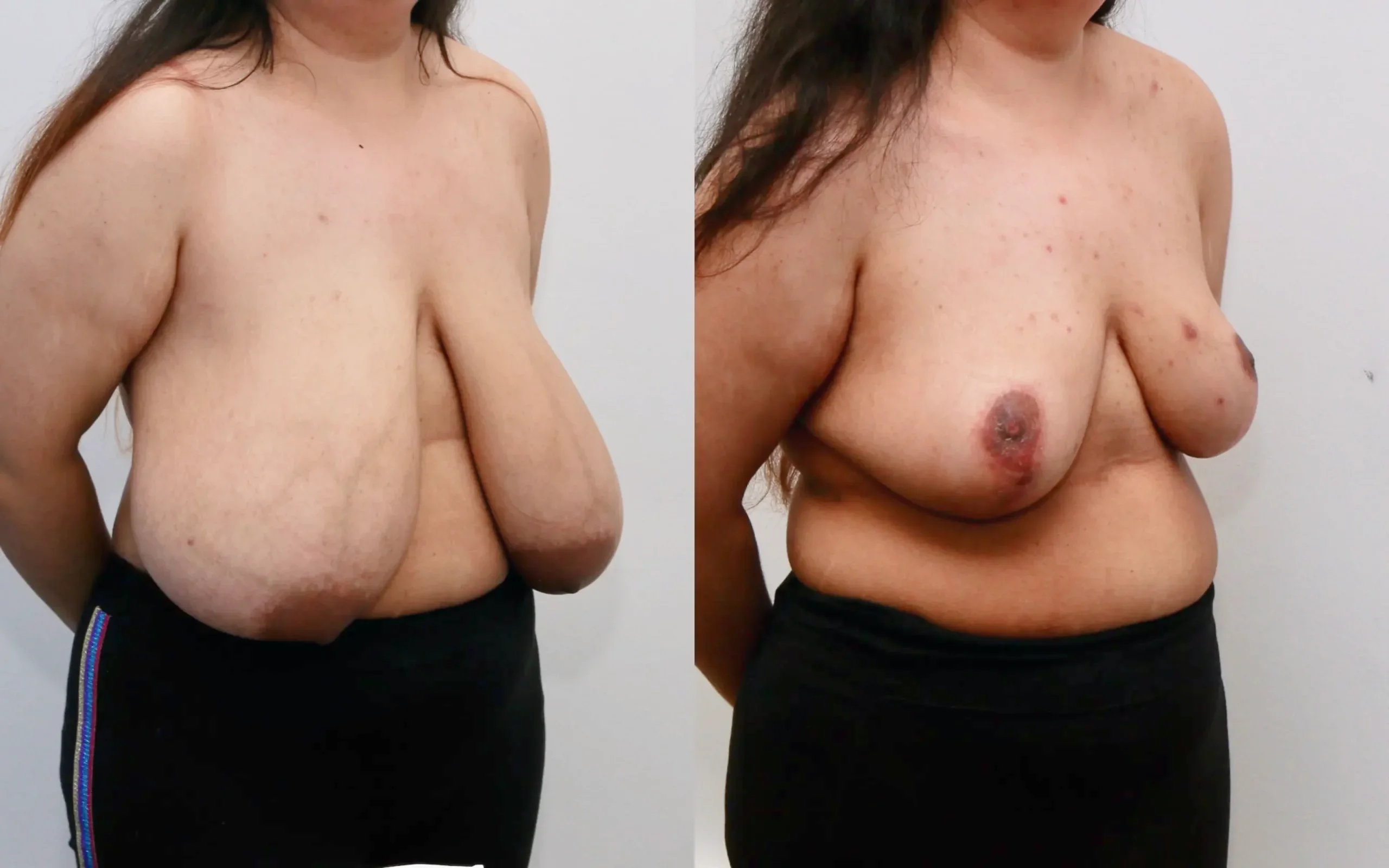 breast reduction