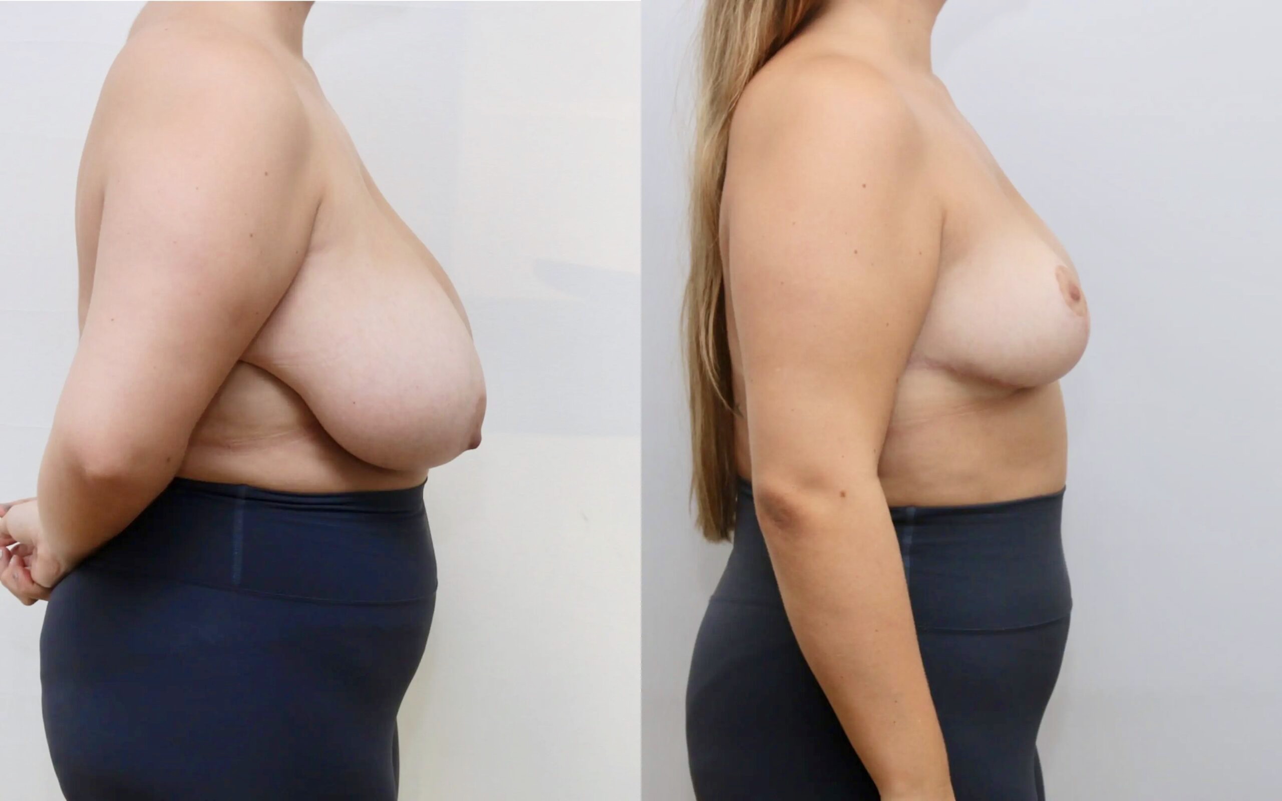 breast reduction