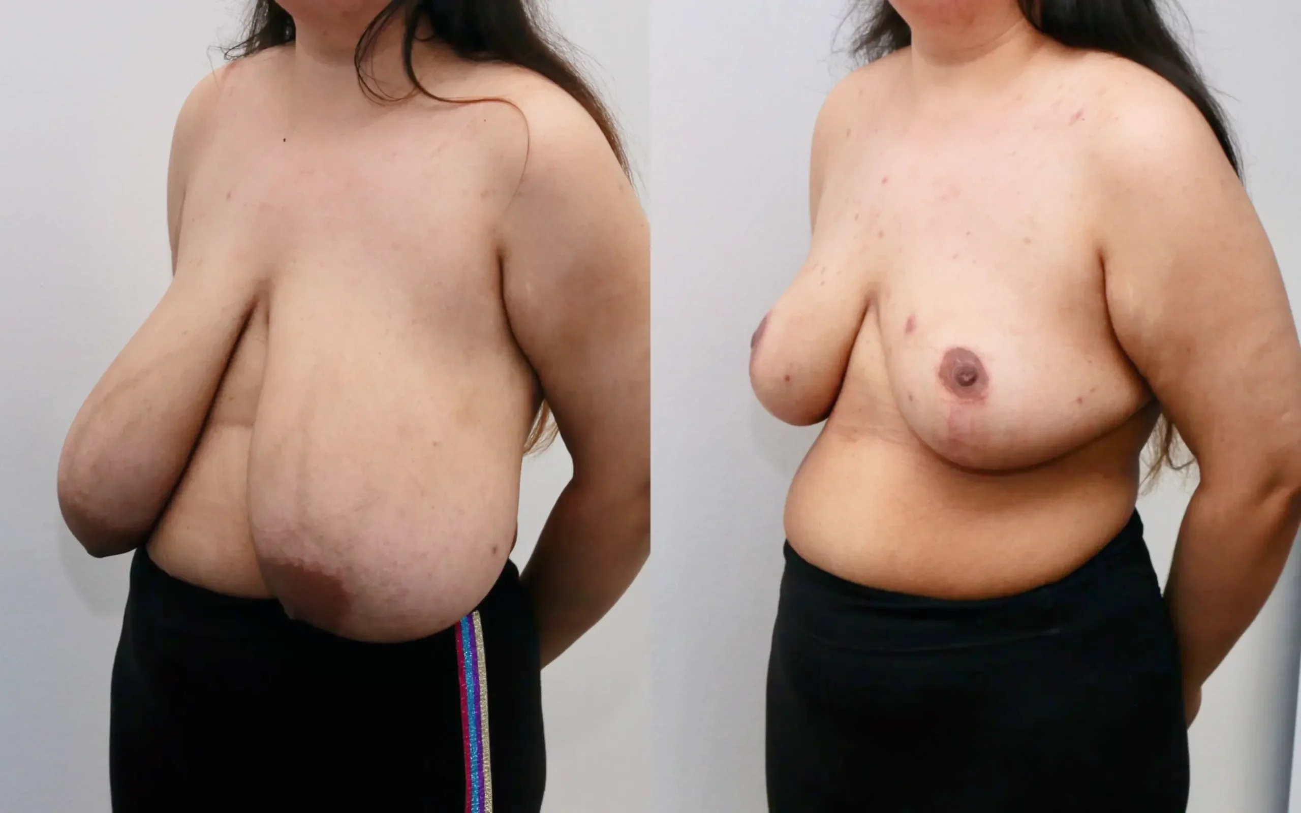 breast reduction