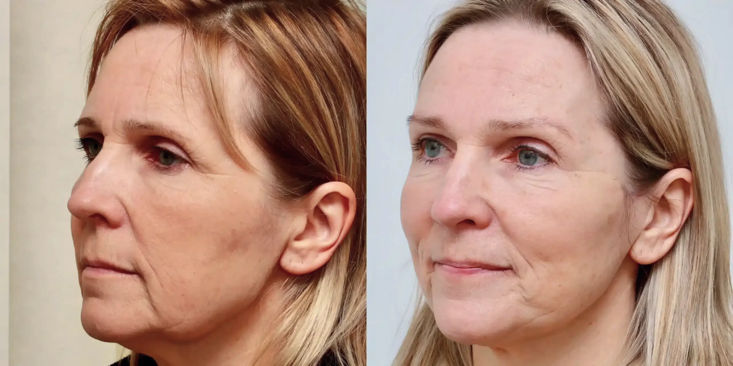 brow lift Edinburgh