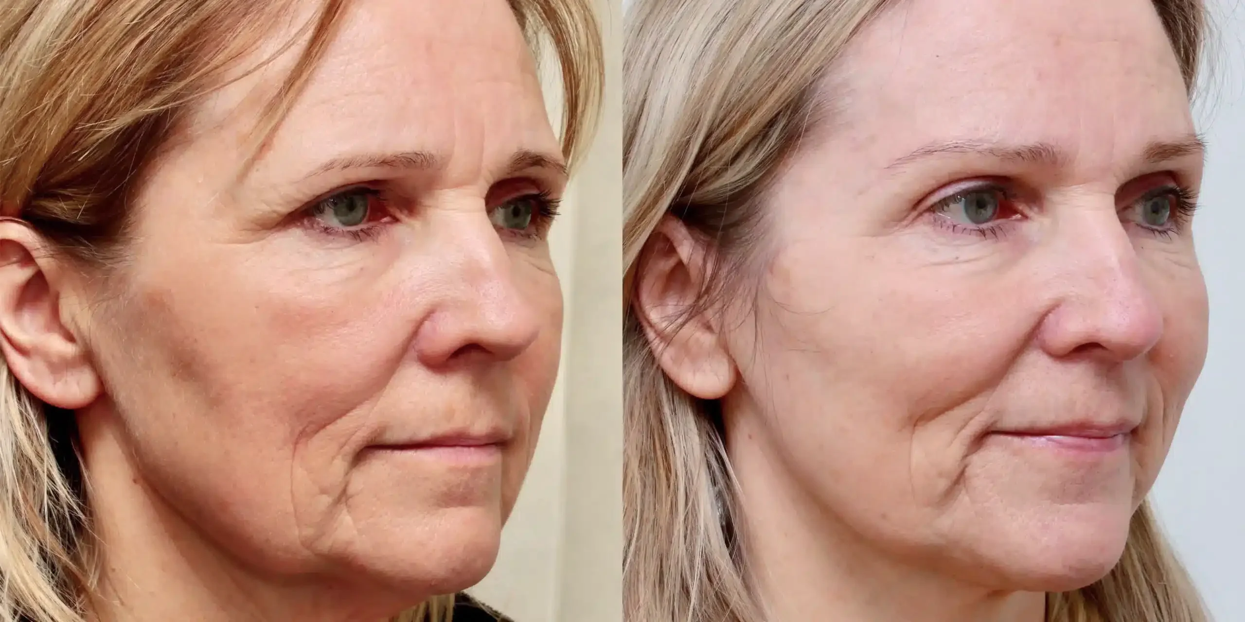 brow lift Edinburgh