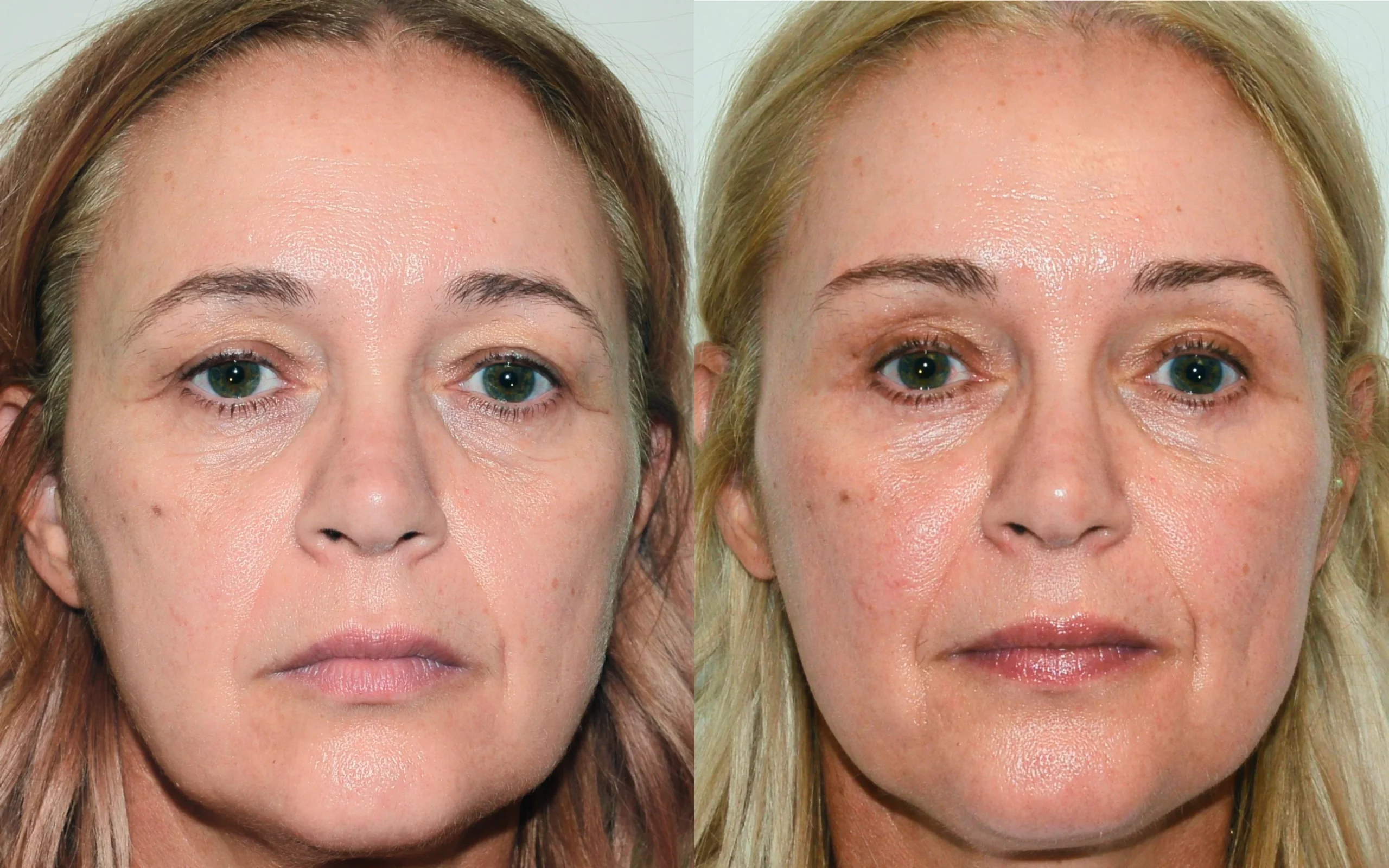Brow lift Scotland