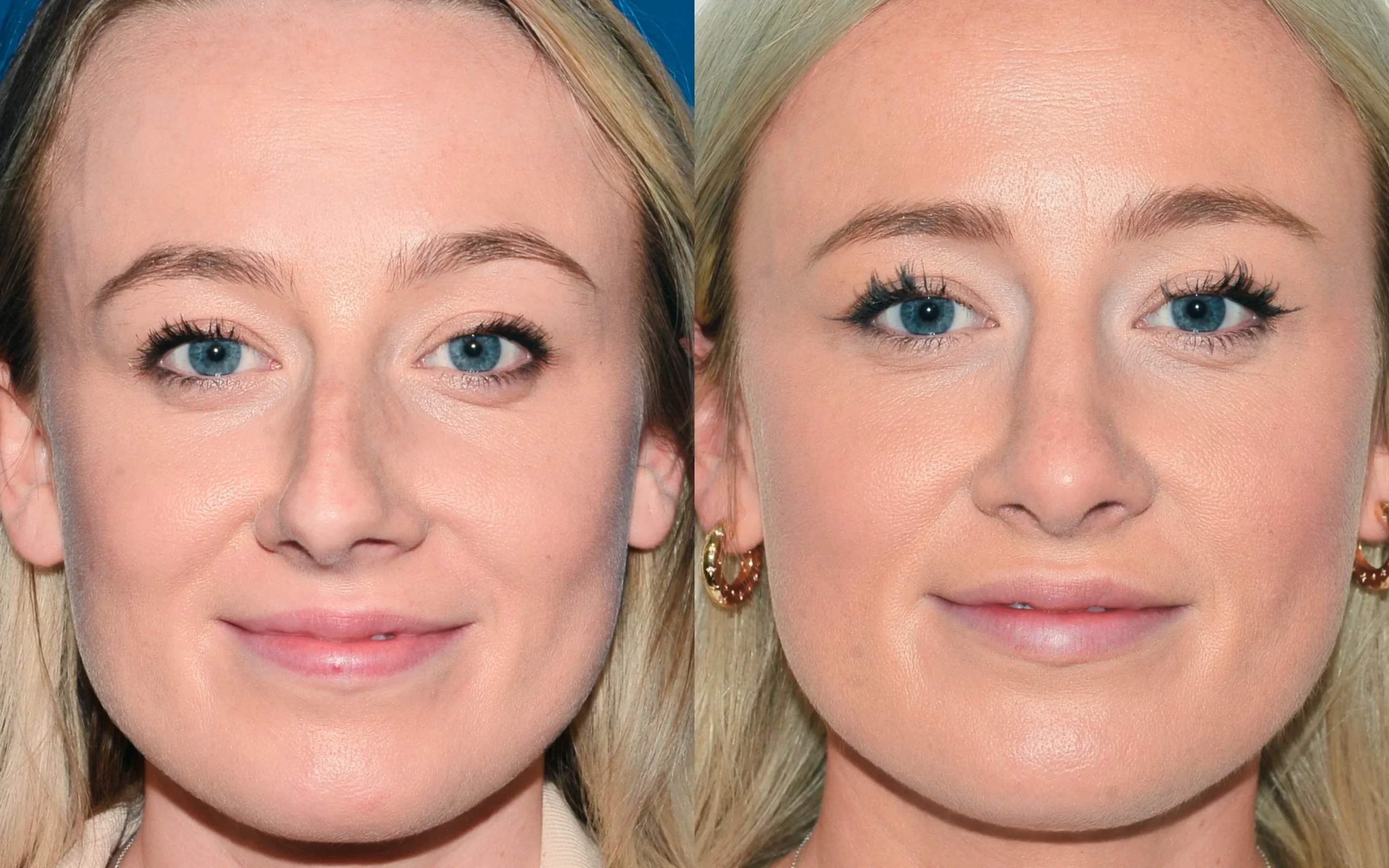 rhinoplasty before after
