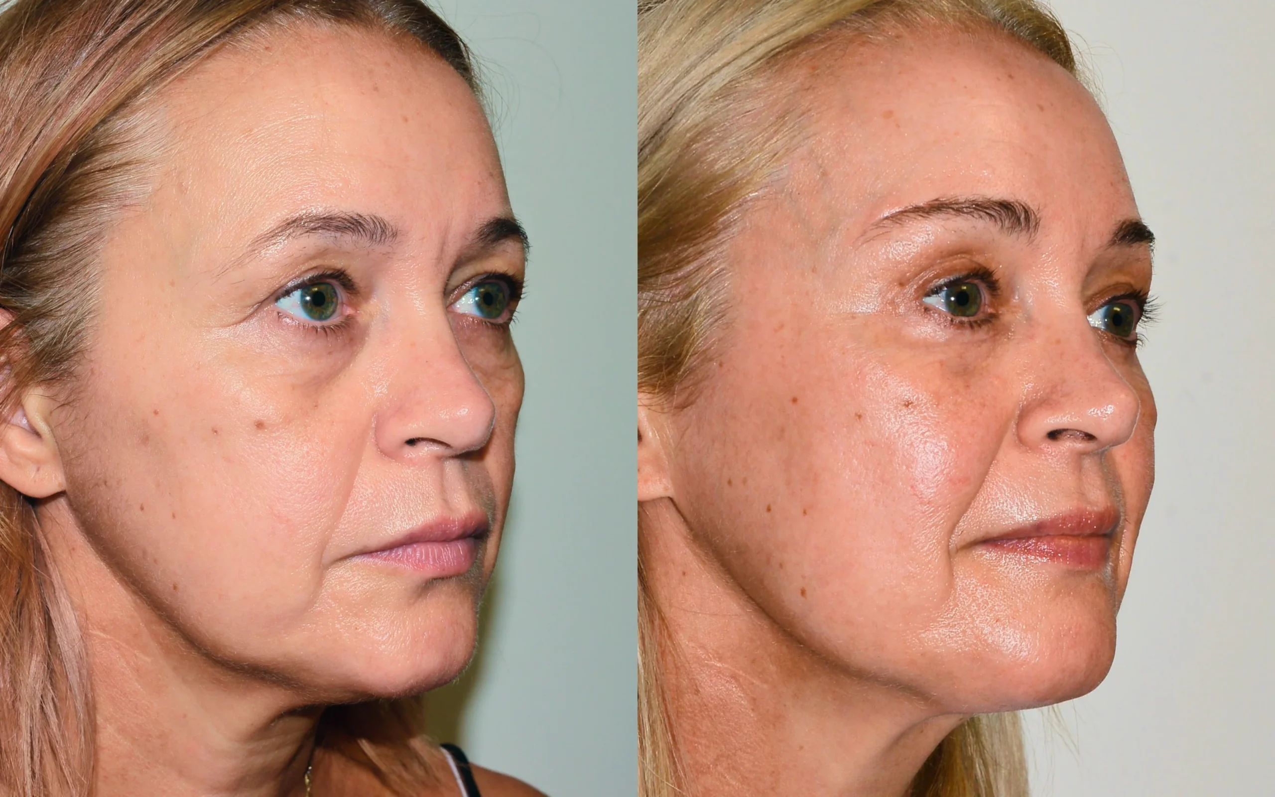 Brow lift Scotland