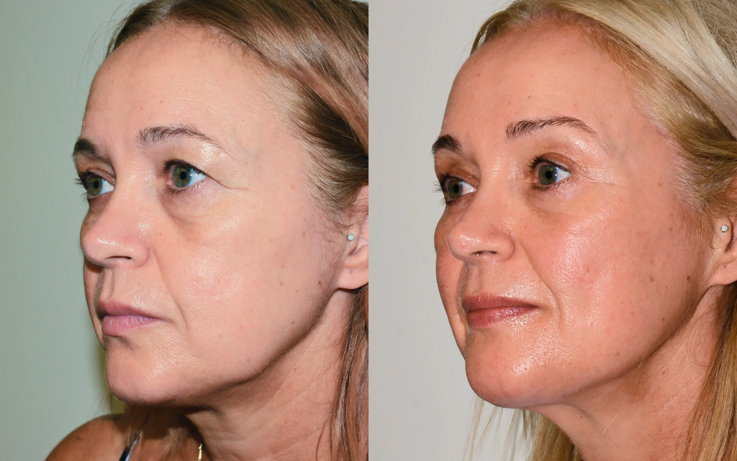 Brow lift Scotland
