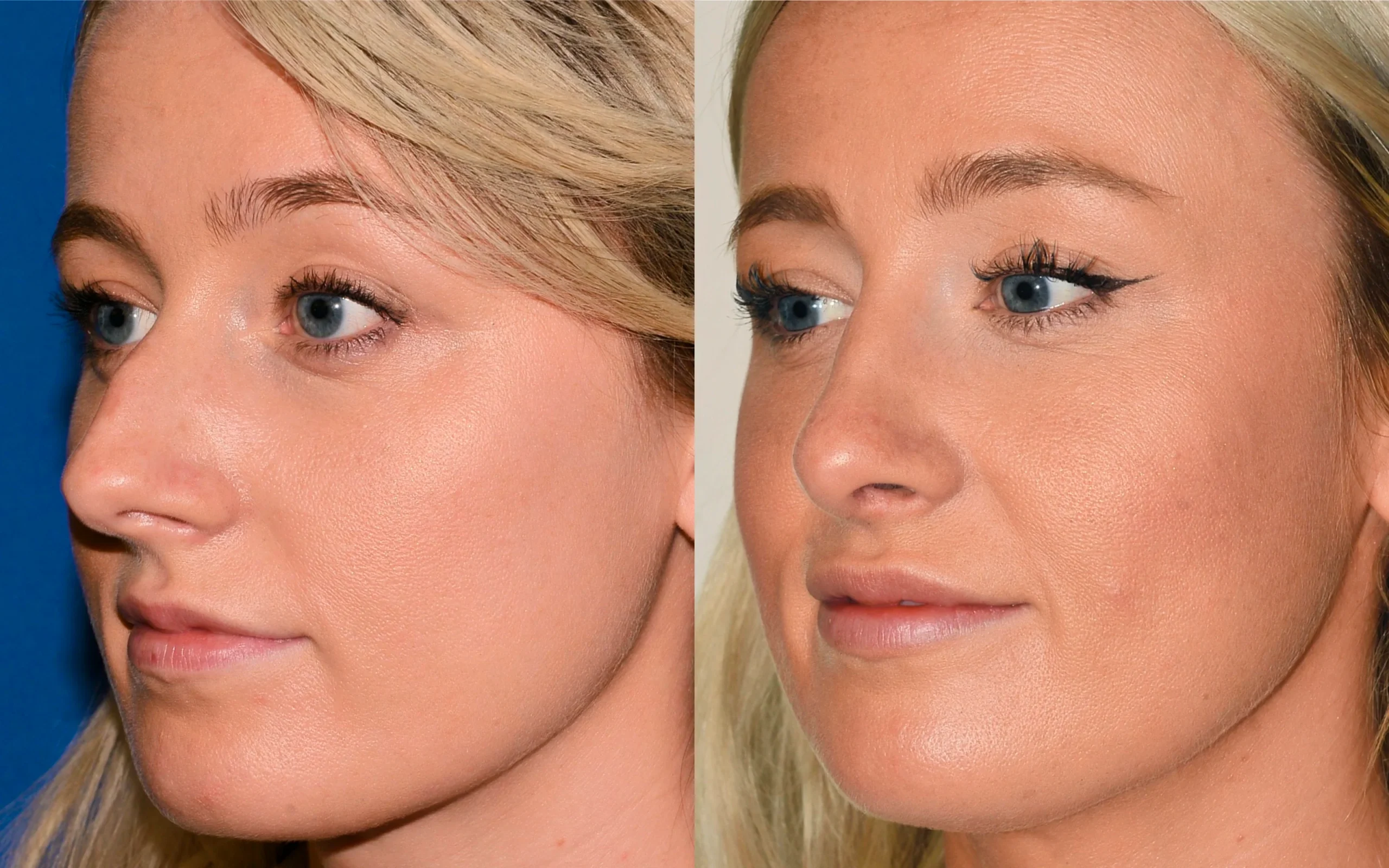 rhinoplasty before after