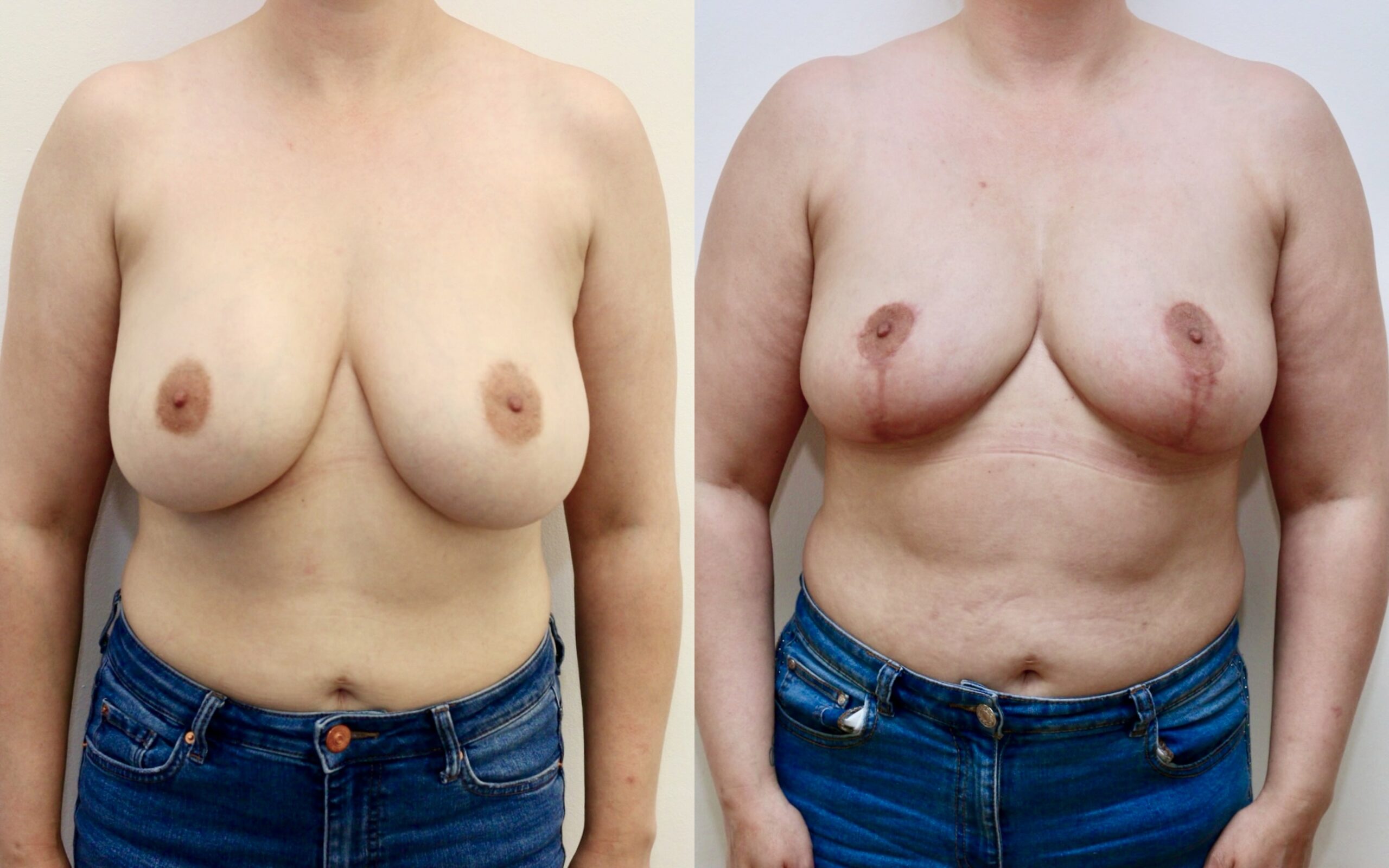 implant removal fat transfer and uplift
