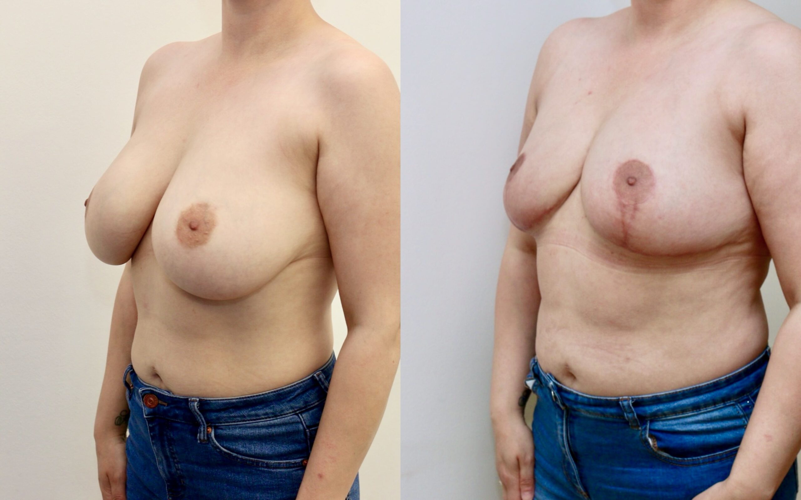 implant removal fat transfer and uplift