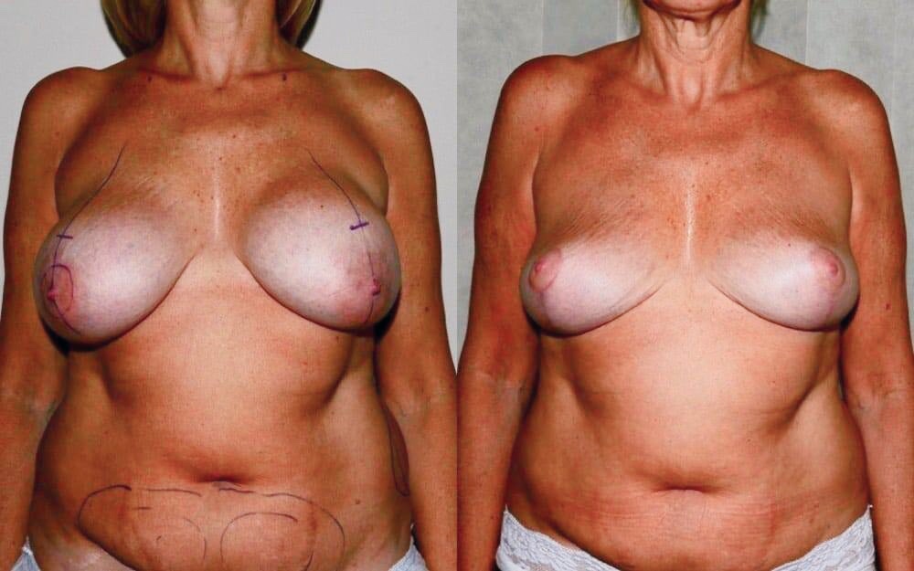 implant removal fat transfer and uplift