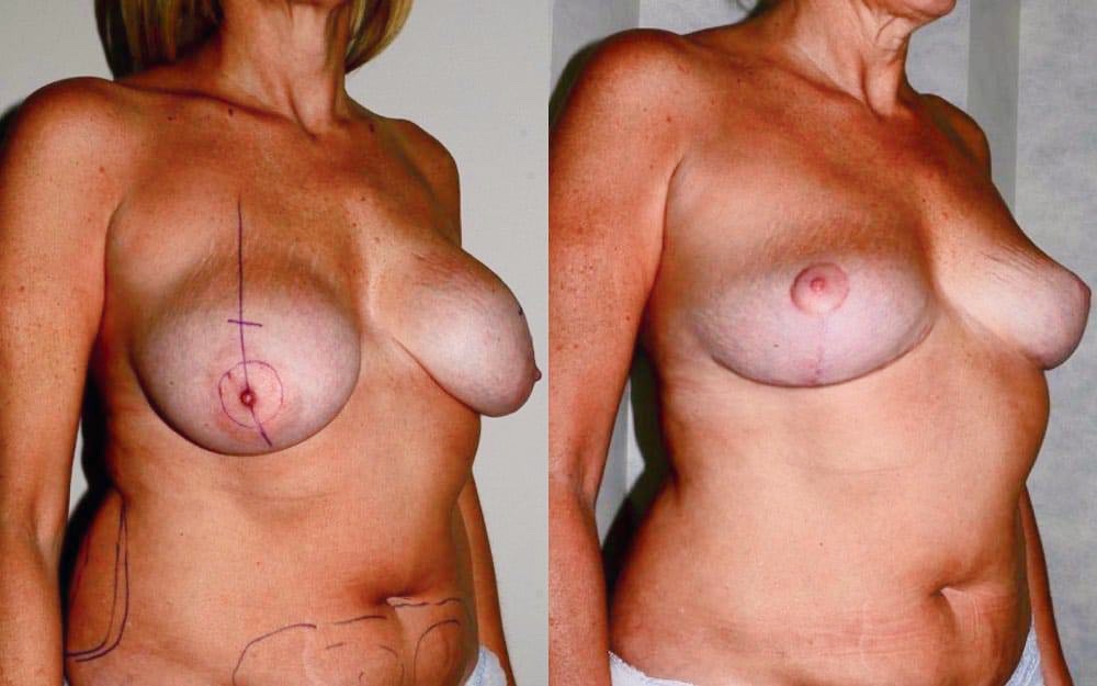 implant removal fat transfer and uplift