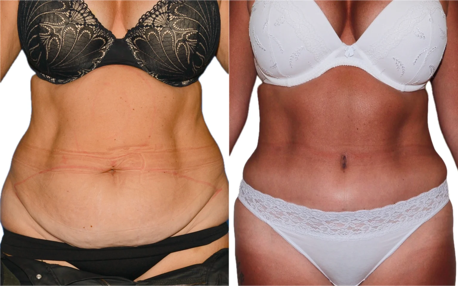 tummy tuck edinburgh
