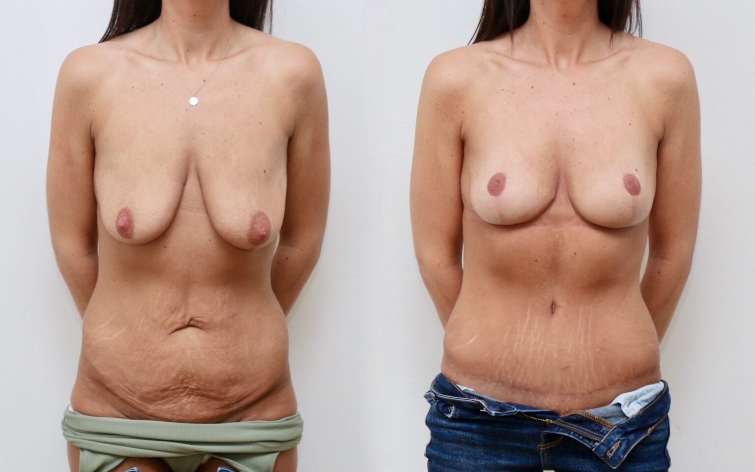 Post weight loss
