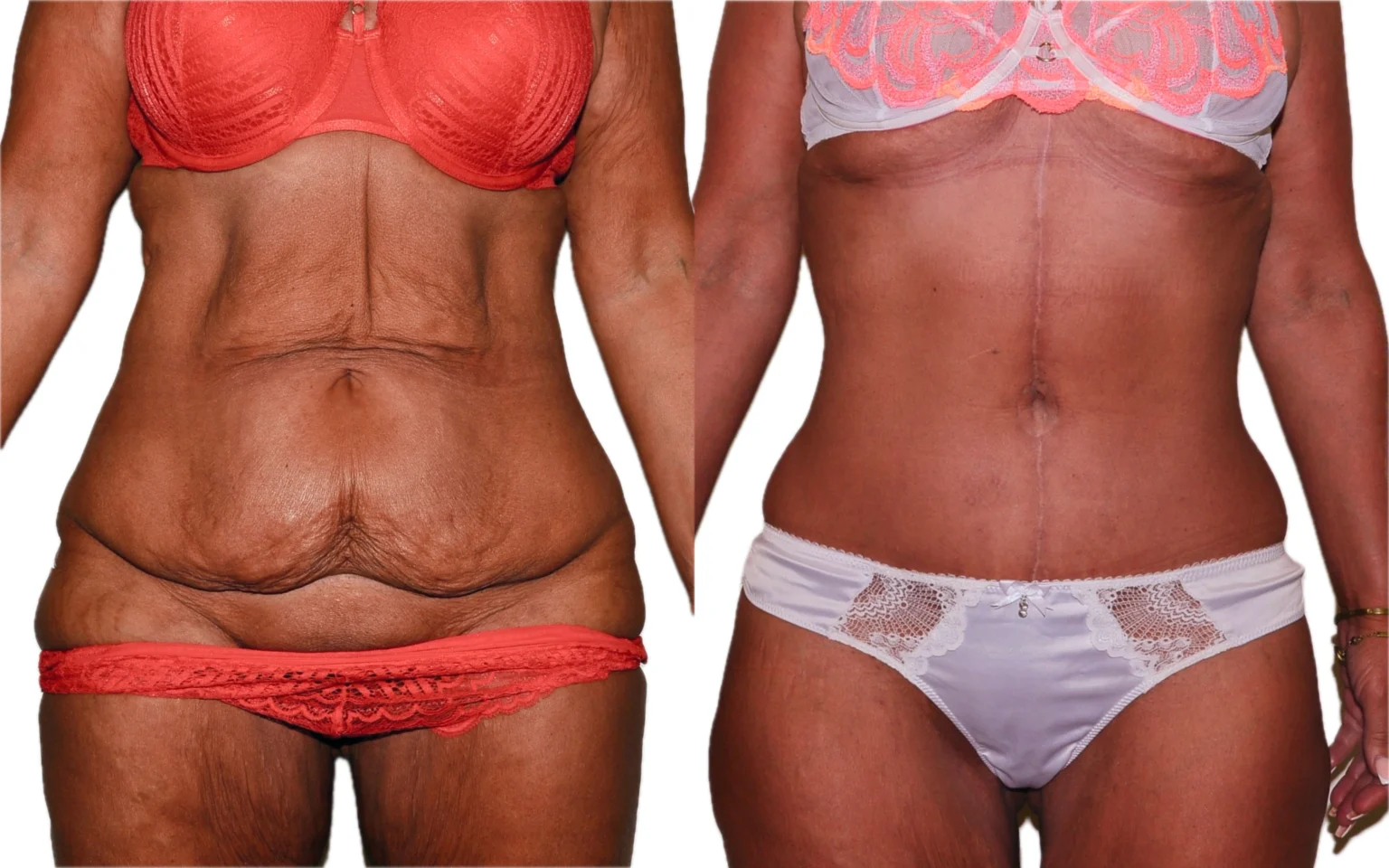 Post weight loss