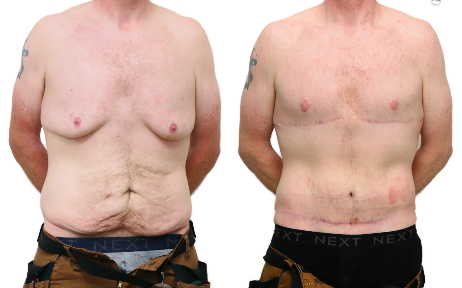 Post weight loss