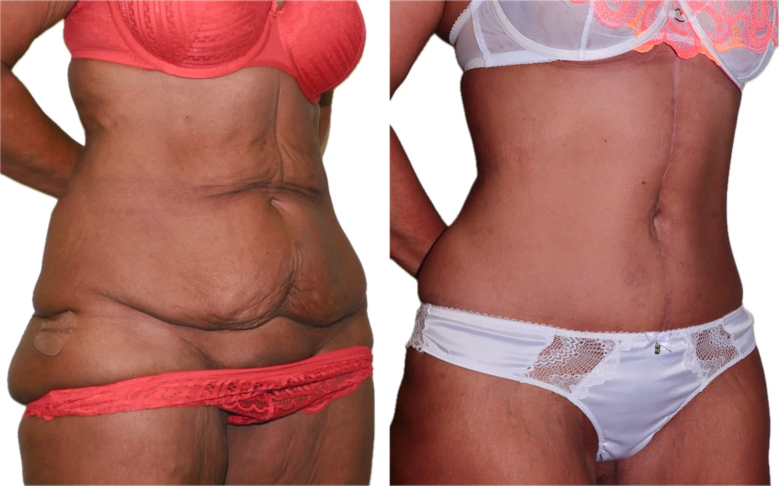 Post weight loss