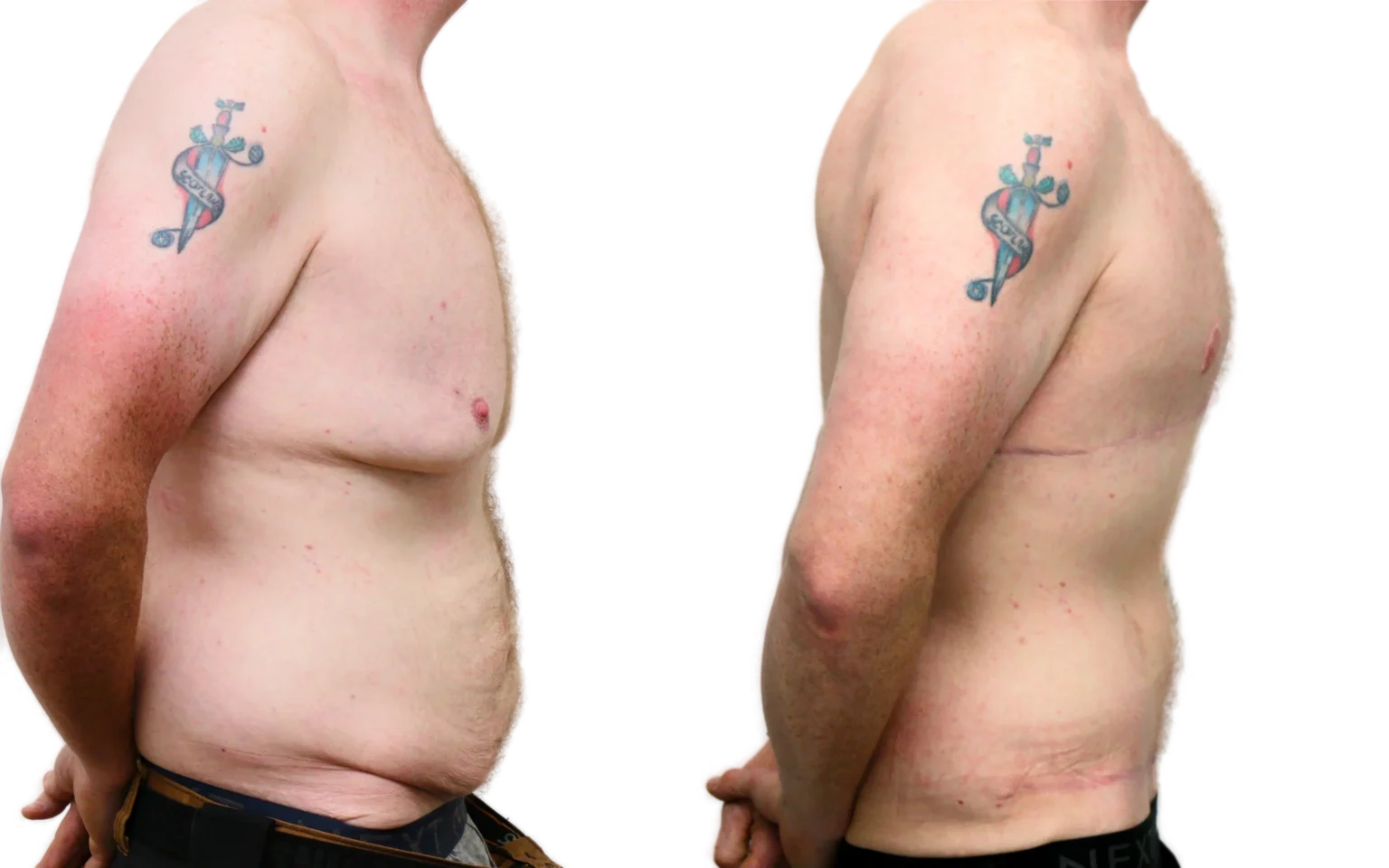 Post weight loss