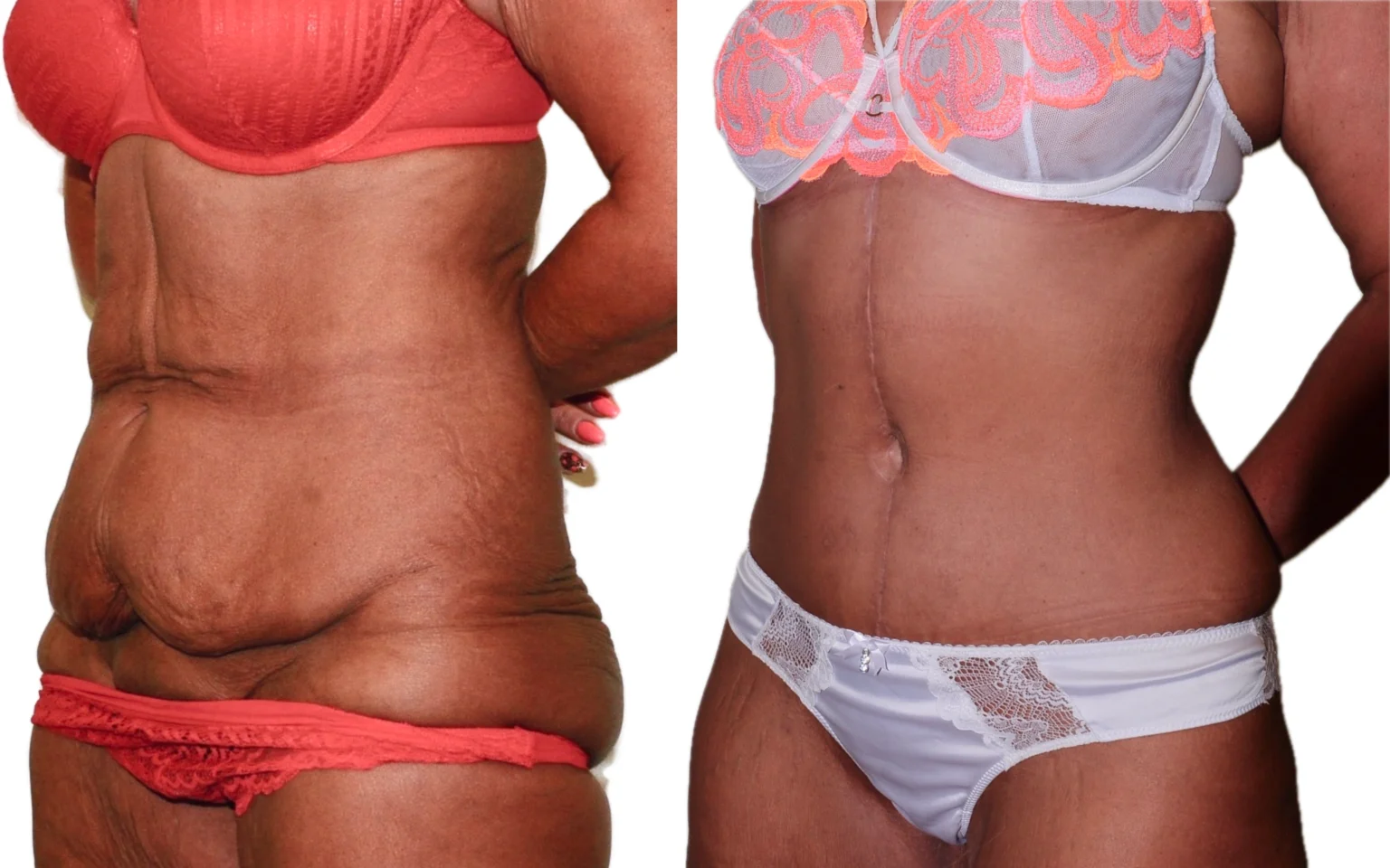Post weight loss