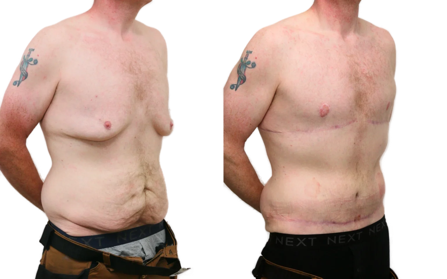 Post weight loss