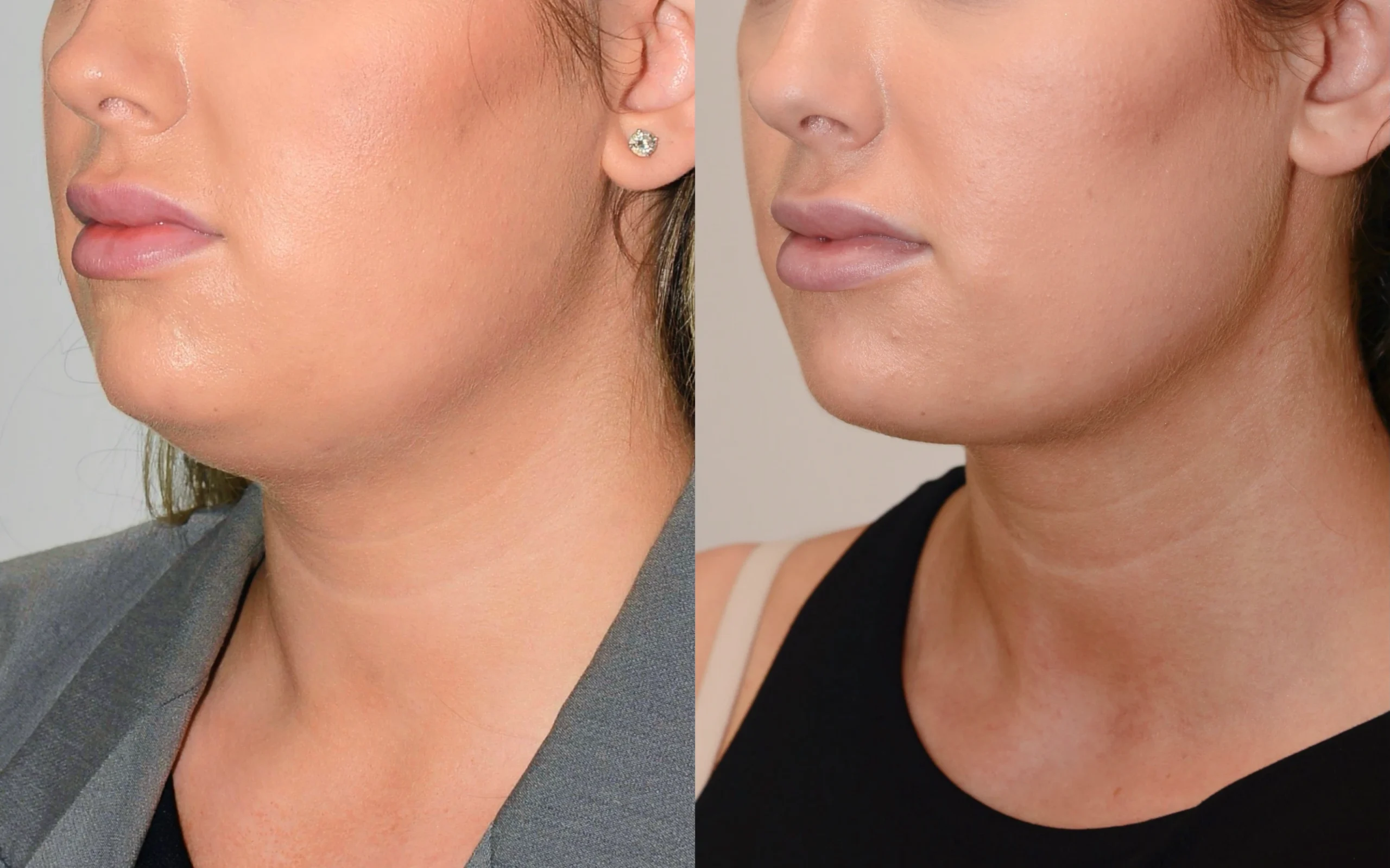 Neck liposuction
