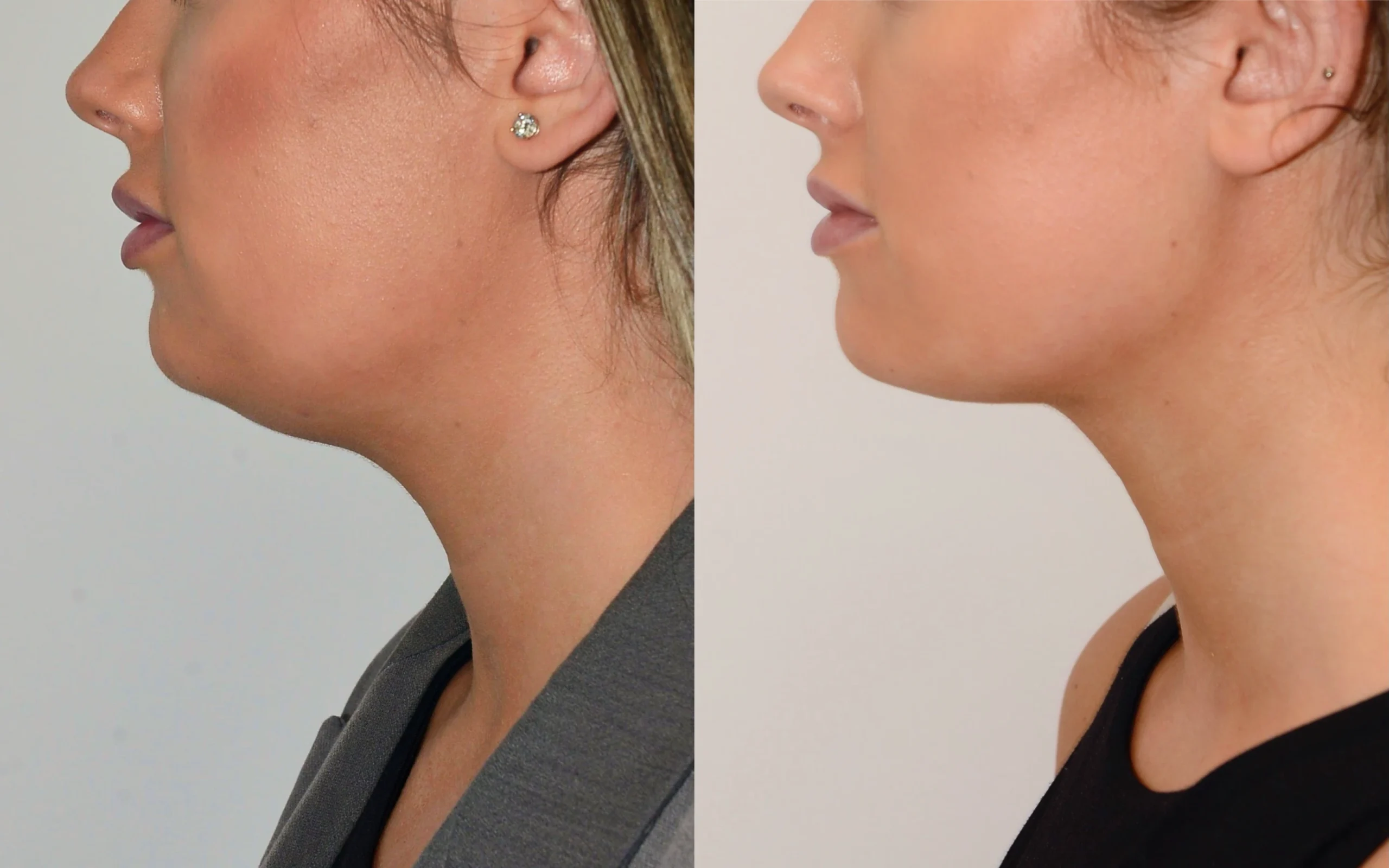 Neck liposuction