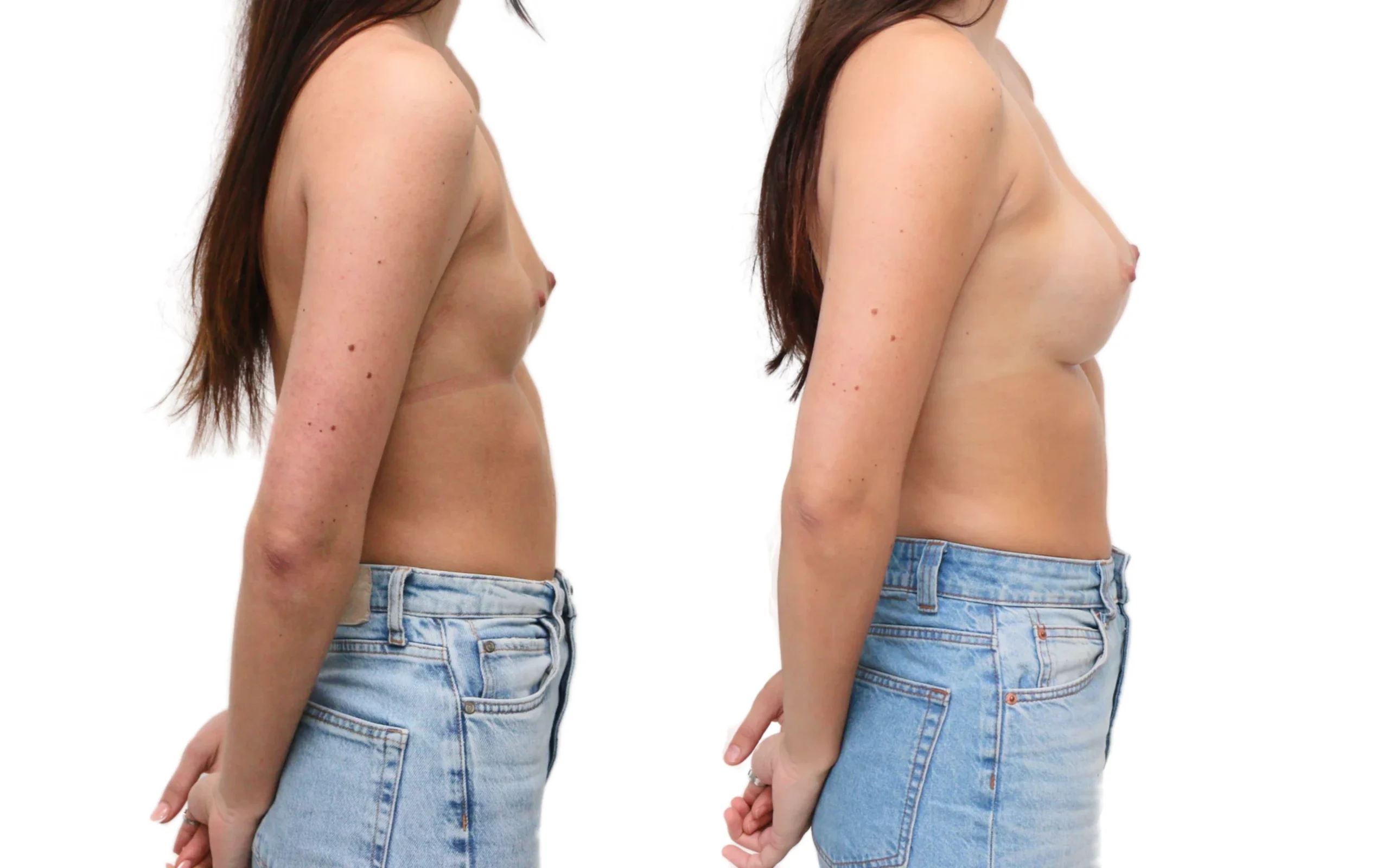 Breast Asymmetry