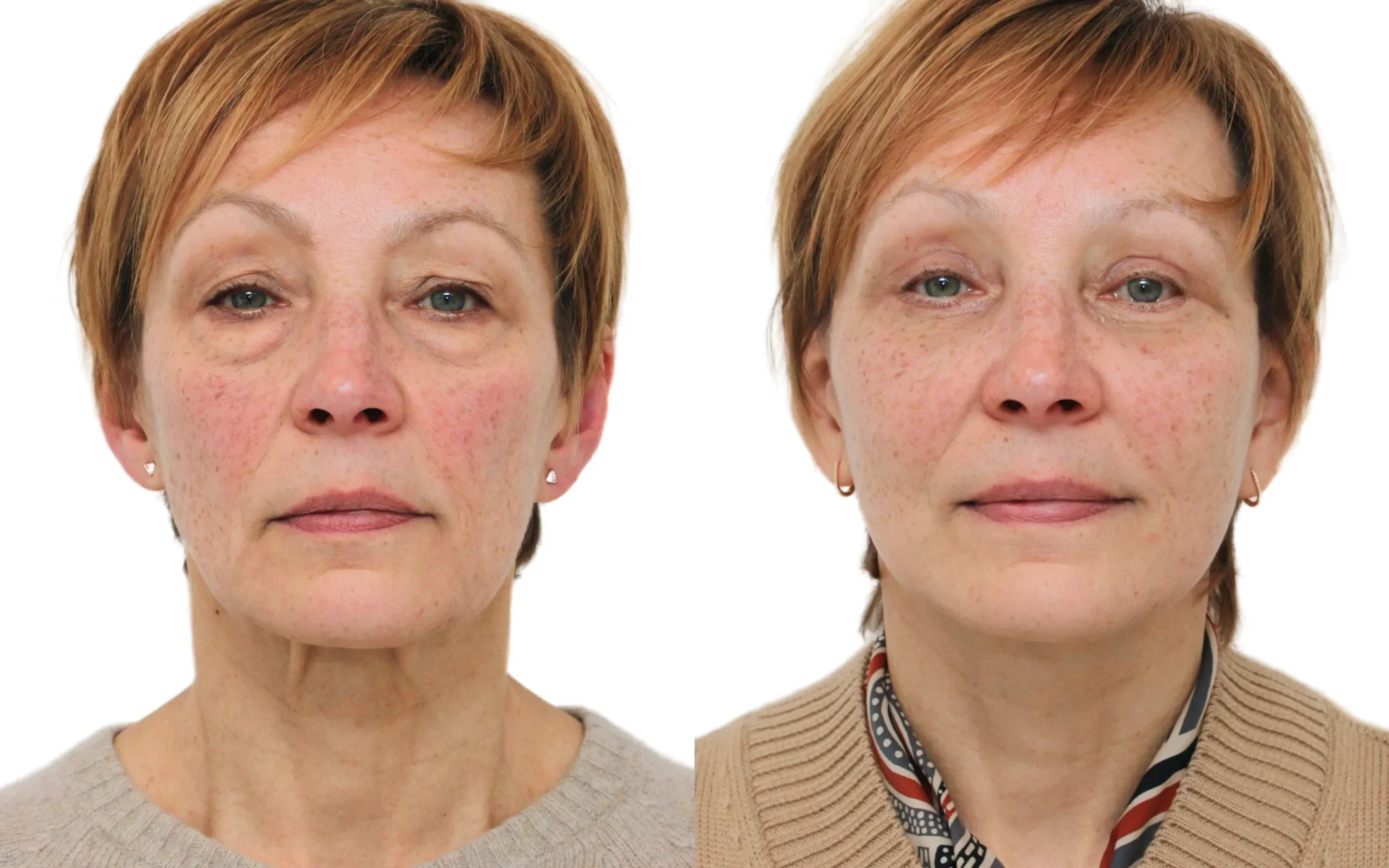 lower eyelid surgery