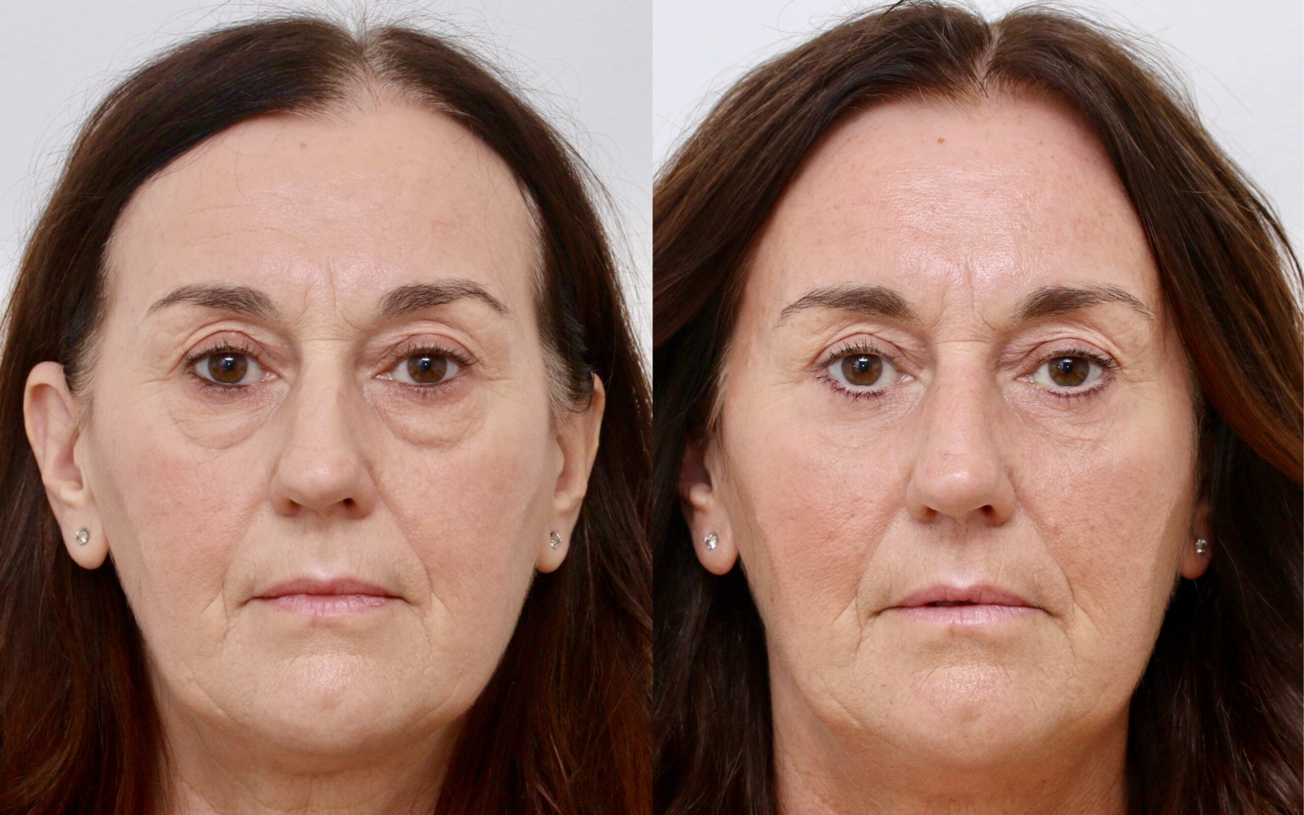 eye bag removal scotland