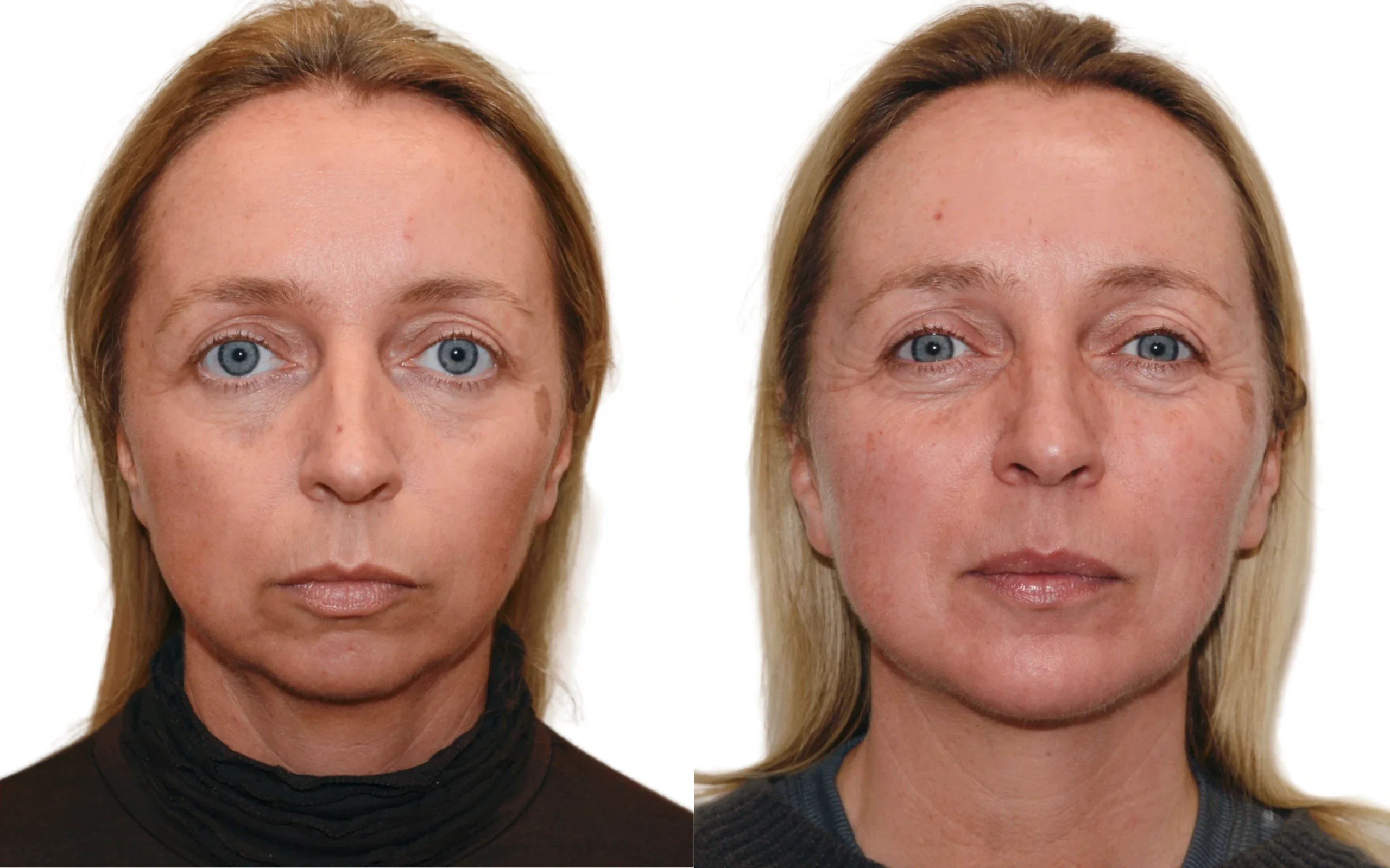 chin implant UK
