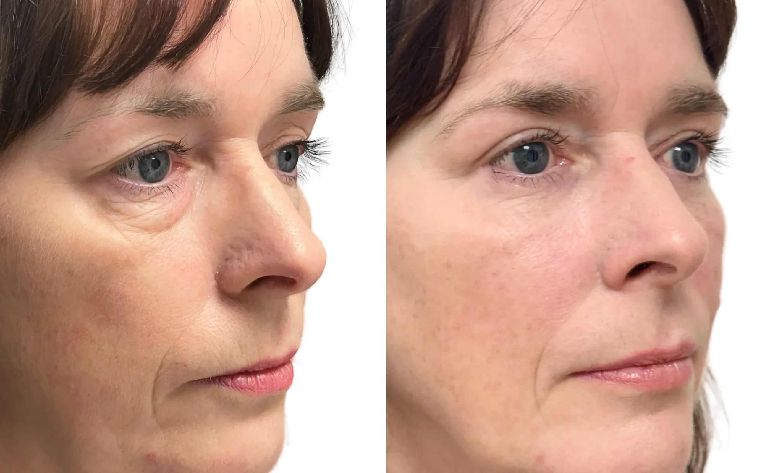 Eyelids – Lower Blepharoplasty