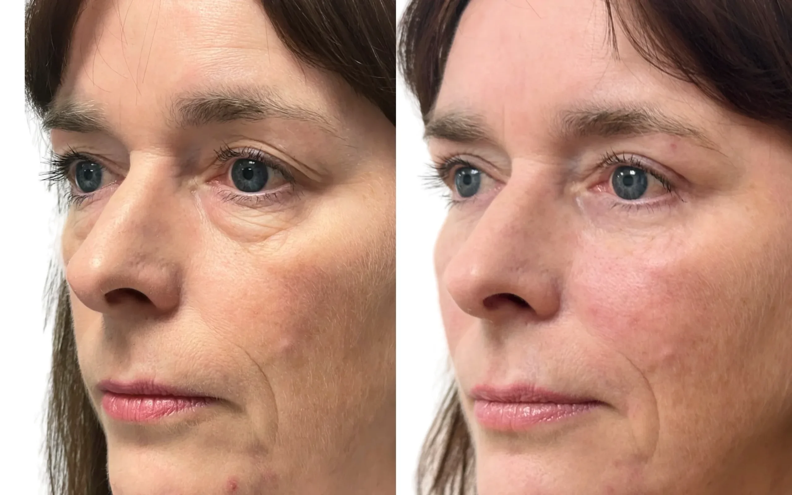 Eyelids – Lower Blepharoplasty